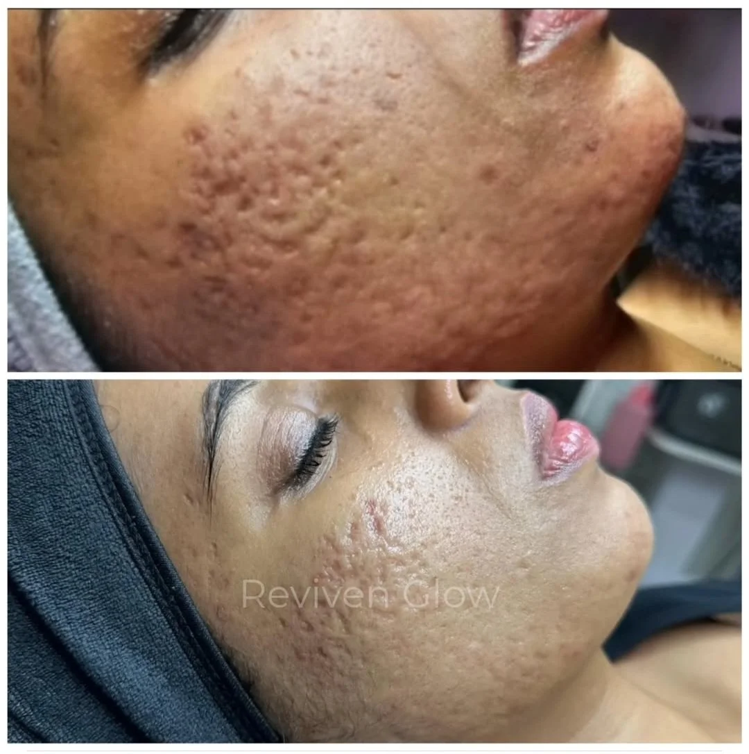 Side-by-side comparison of a woman's face showing severe acne scars before and after skincare treatment. The top image displays prominent pitted scars, while the bottom image shows significantly smoother skin with reduced scars.
