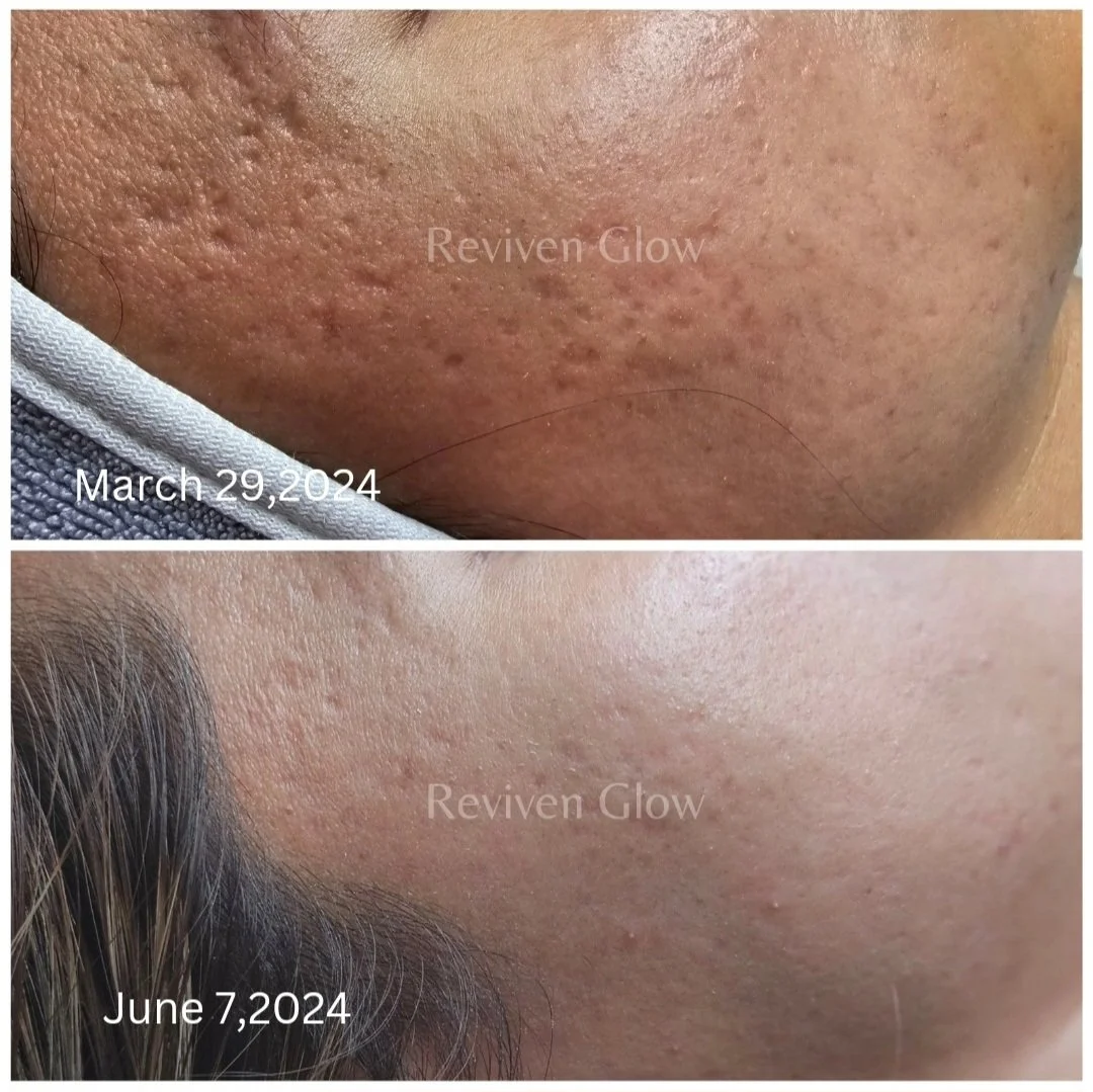 Comparison of skin showing improvement in skin texture and acne scars from March 29, 2024 to June 7, 2024, with smoother skin on the later date.