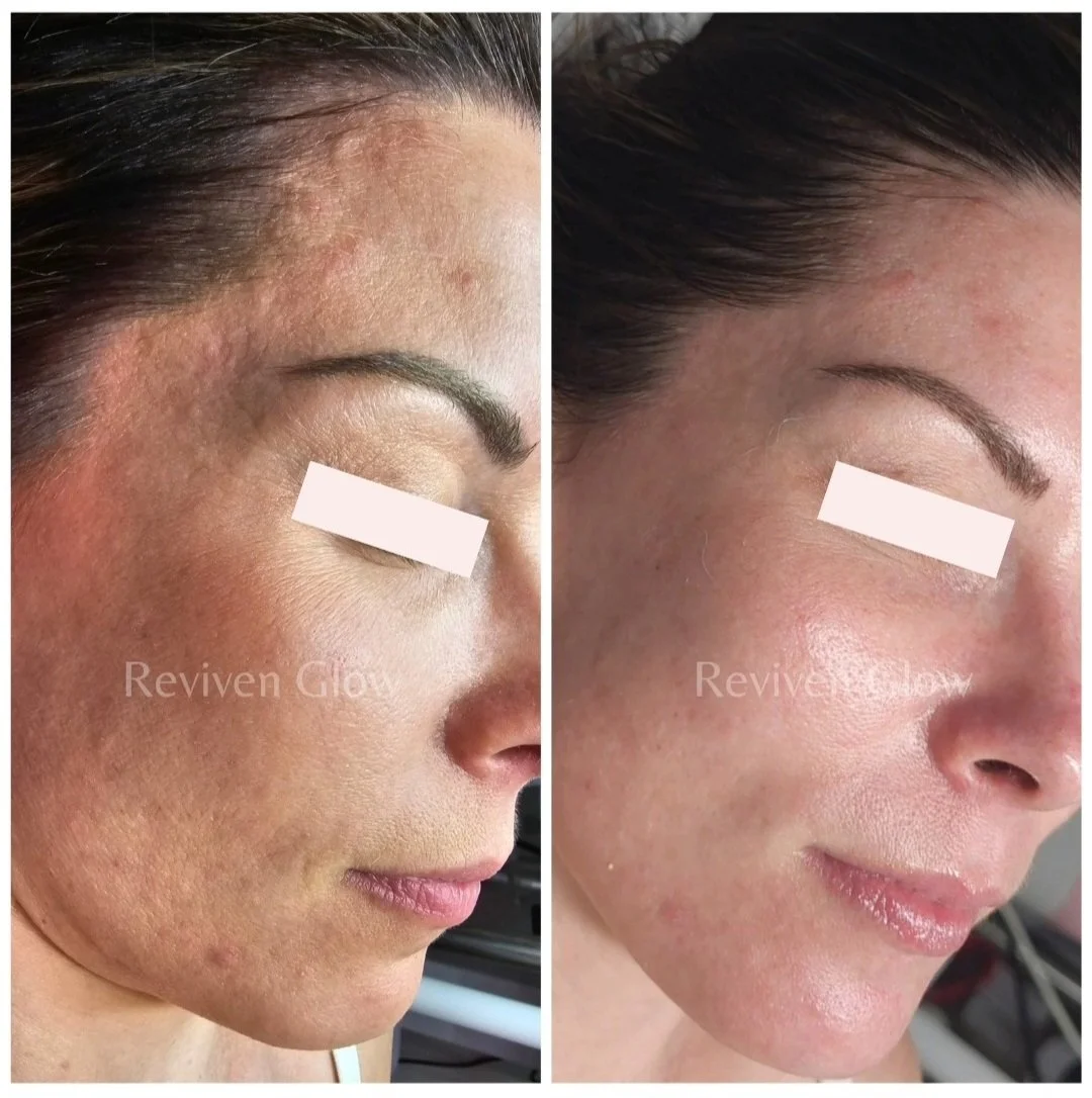 Side-by-side comparison photo showing a woman's face before and after skin treatment. The left shows skin with acne scars and uneven texture, while the right shows clearer, smoother skin.