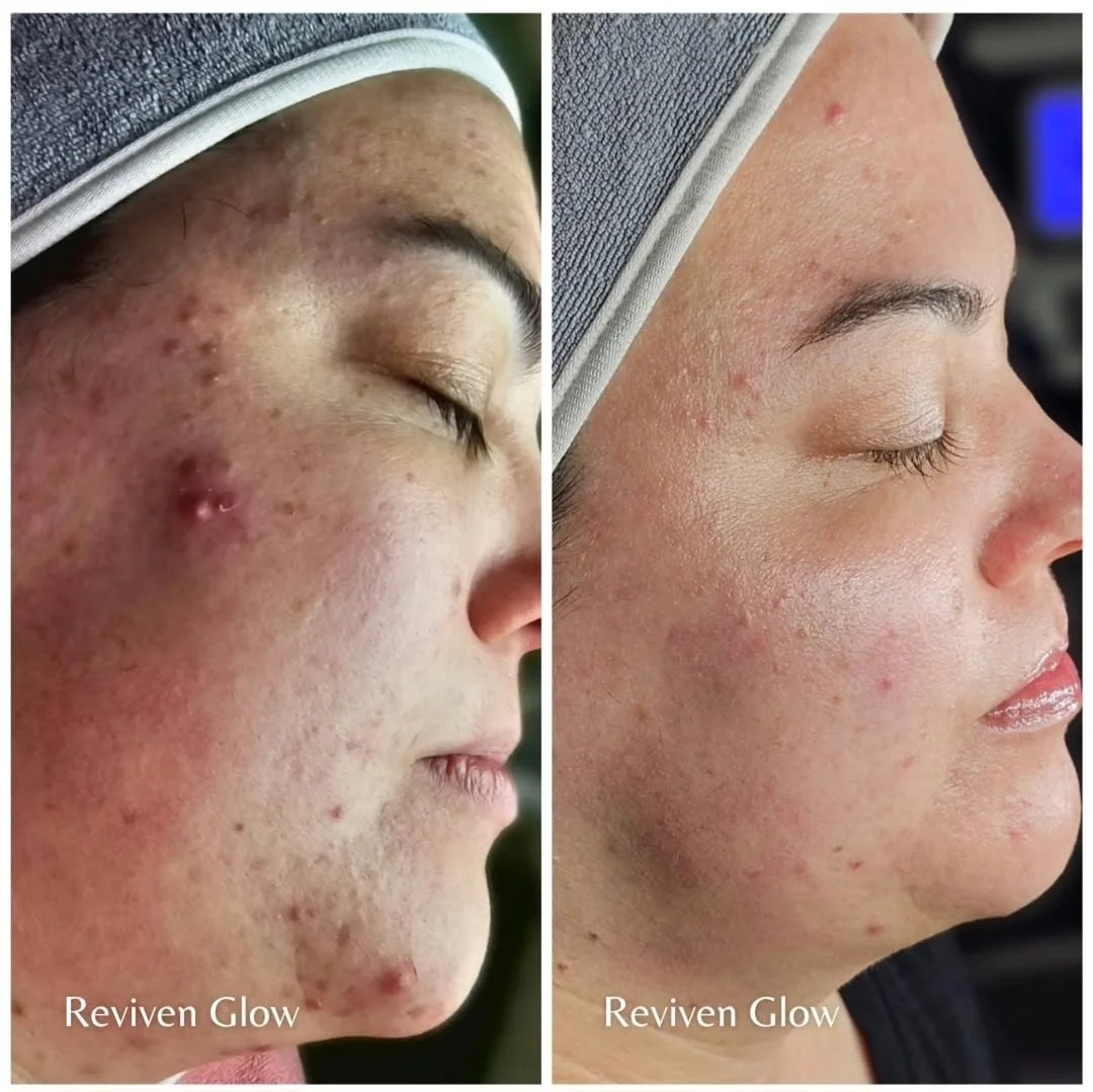 Side-by-side comparison of a woman's face before and after using Reviven Glow skincare product. The left shows acne, redness, and blemishes; the right shows clearer skin with fewer imperfections.