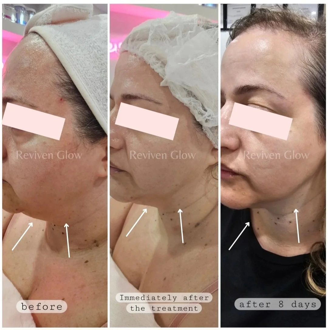 Progress photos showing a woman's face before, immediately after, and 8 days after a skincare treatment. The first image shows skin with hyperpigmentation and spots, the second shows the skin right after the treatment with some relaxation of spots, and the third shows improvement with clearer skin at 8 days post-treatment.