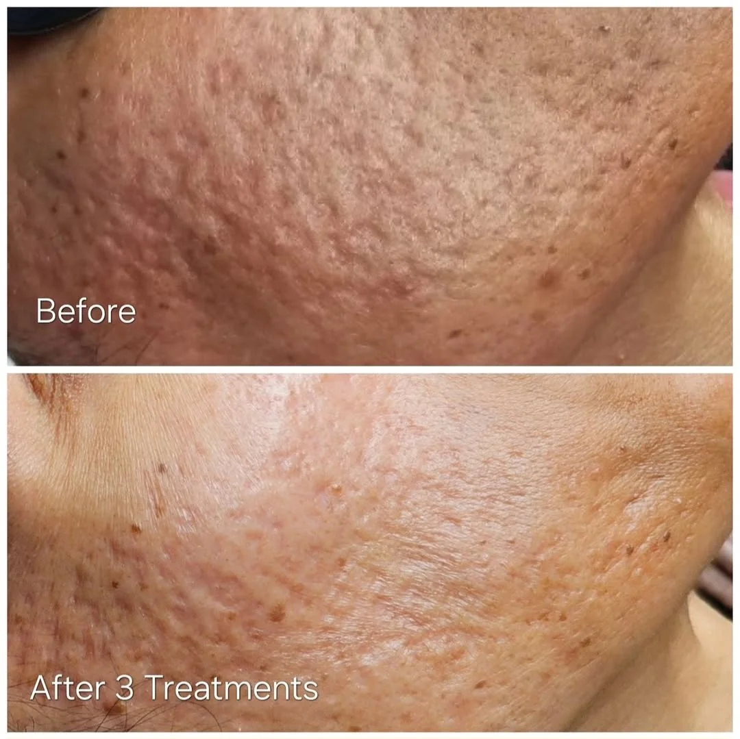 Close-up of skin before and after three treatments showing improved skin texture and reduced hyperpigmentation.