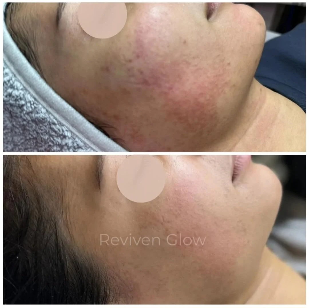 before and after images showing skin improvement on a person's cheek, with the after photo labeled 'Reviven Glow'.
