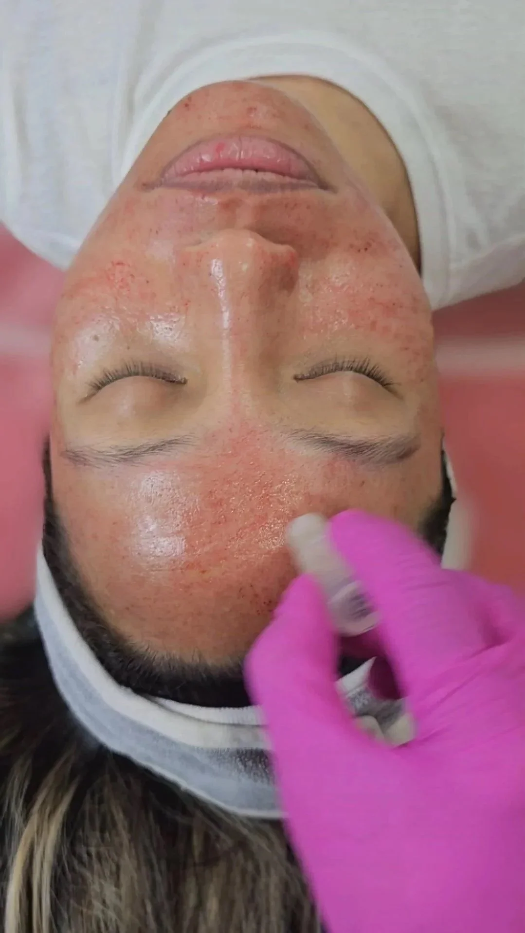 Person lying down receiving a facial treatment, with a gloved hand applying a facial product on her forehead.