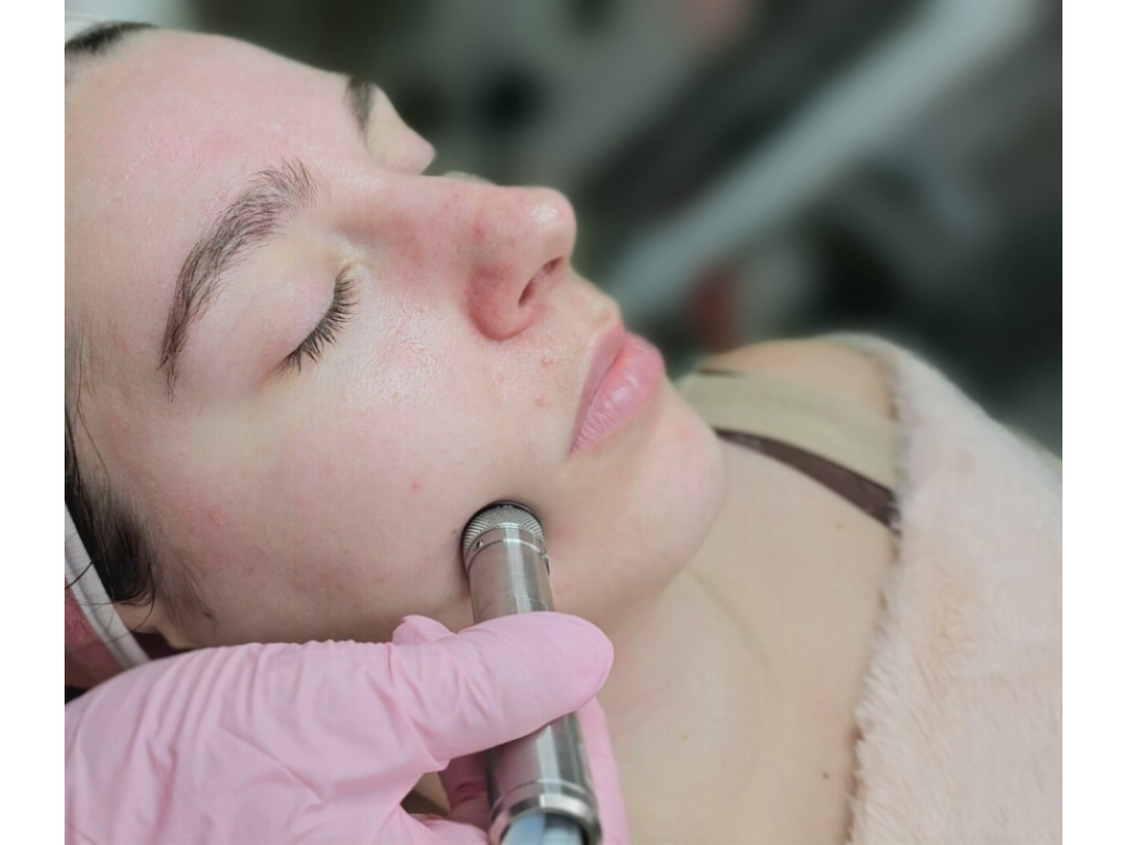 Close-up of a woman with closed eyes receiving a cosmetic procedure with a medical device, while lying down, with a person's gloved hand holding the device.