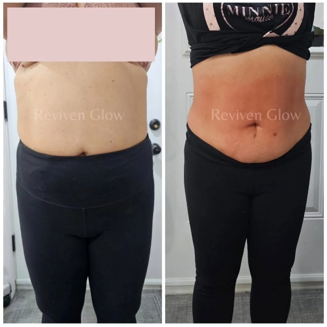 Comparison of a woman's midsection before and after a skin treatment, showing a reduction in skin blemishes and improved skin appearance.