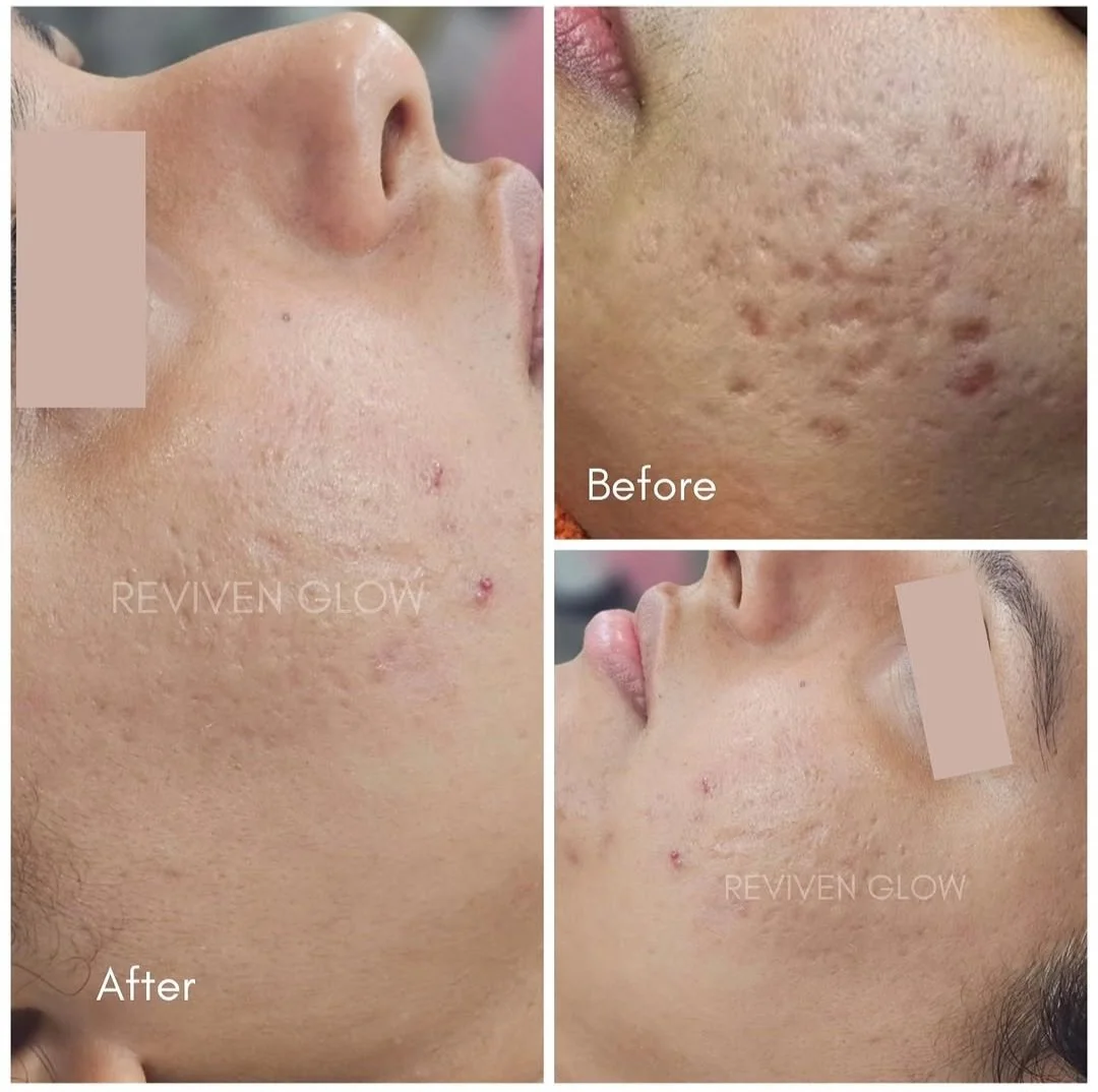 A collage showing a person's face before and after acne treatment. The top right image shows acne scars and blemishes. The bottom right and left images show clearer skin after treatment.