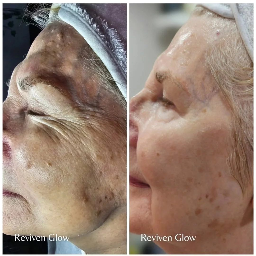 Side-by-side comparison of a woman's face before and after skincare treatment, with the label 'Reviven Glow' on both images.