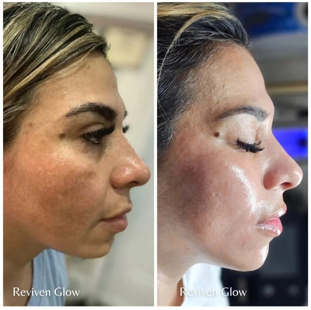 Side-by-side comparison of a woman before and after skincare treatment, showing improved skin clarity, brightness, and glow on the right.