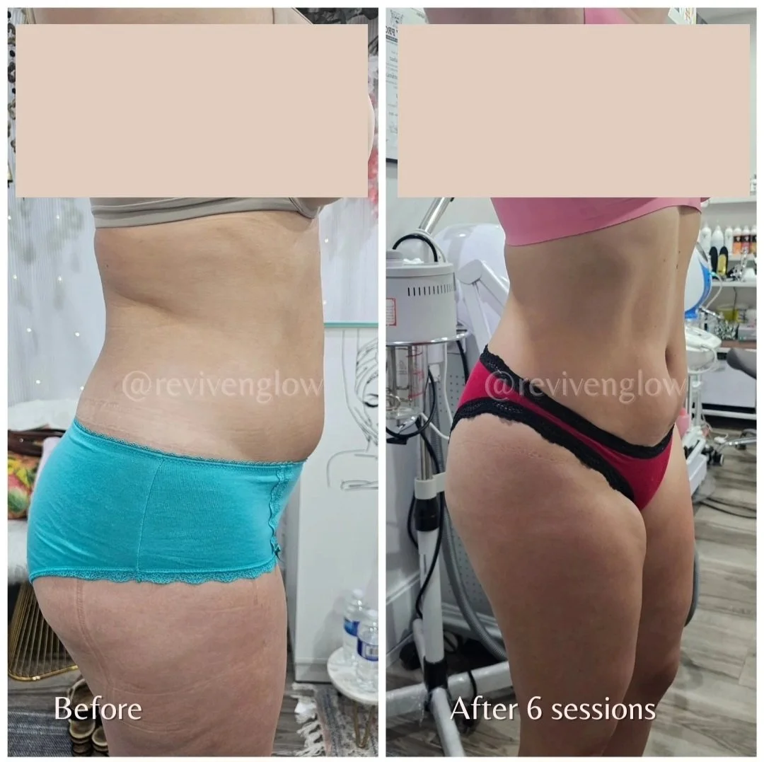 Side-by-side comparison of a woman's abdomen and thighs before and after six treatment sessions. The "before" image shows loose skin and some cellulite, while the "after" image shows a more toned and smooth appearance. The woman is wearing blue underwear in the "before" photo and pink underwear with black lace in the "after" photo.
