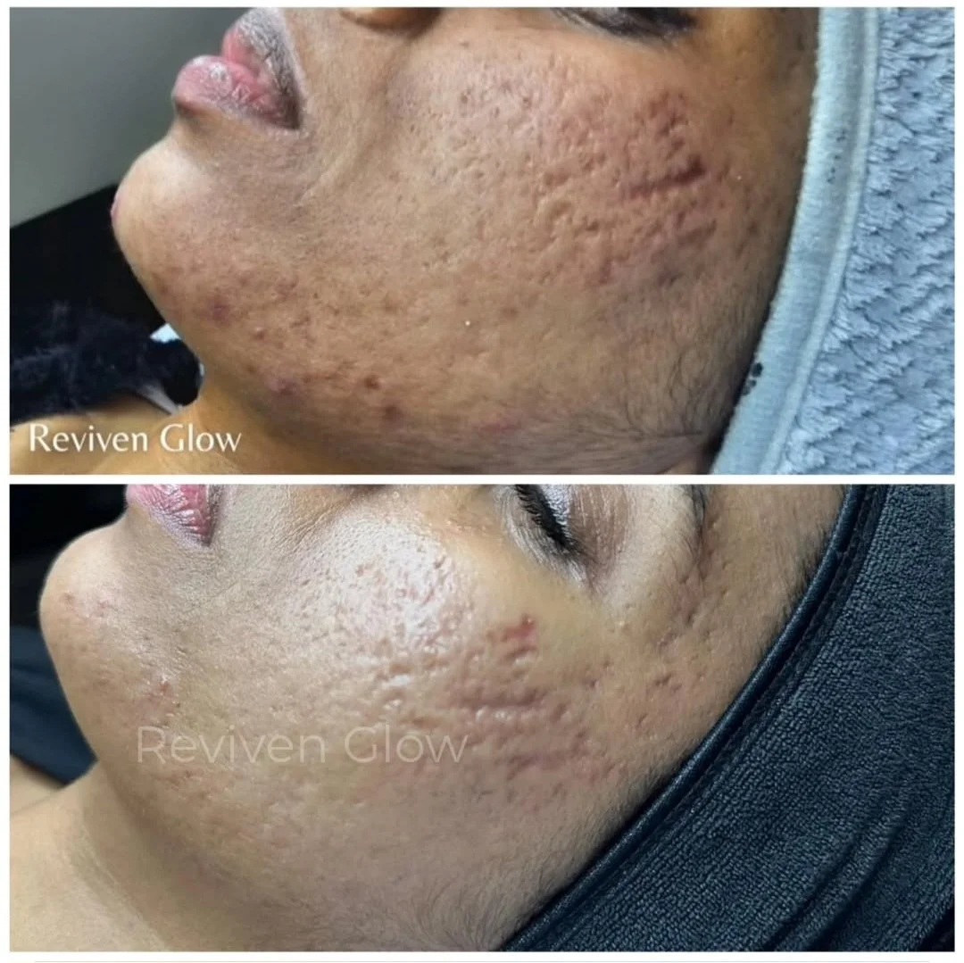 Before and after images of a person's face showing improvement in acne scars, with smoother skin in the after photo.