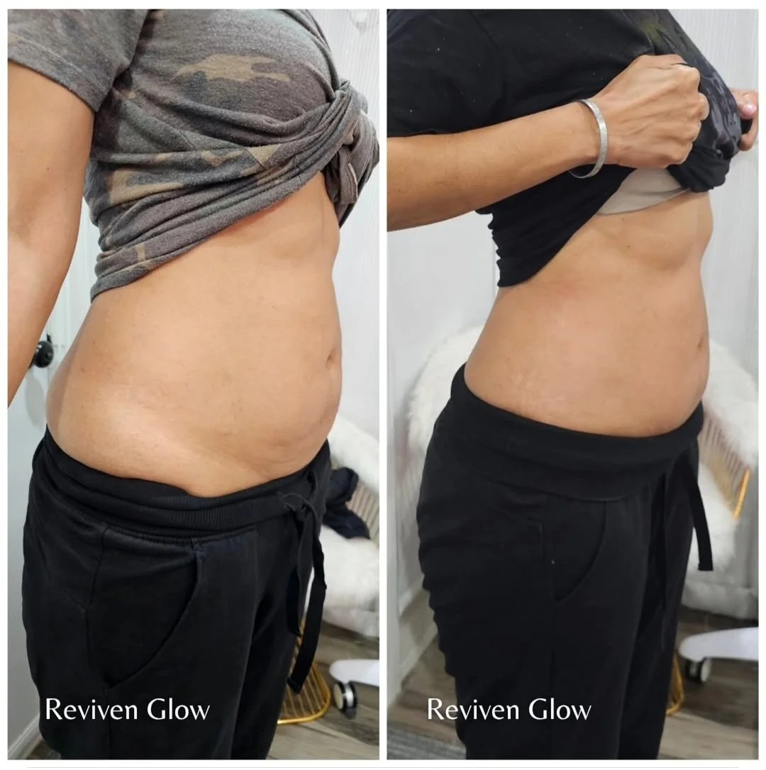 Side-by-side comparison of a person's midsection before and after using Reviven Glow product, showing improved skin appearance.