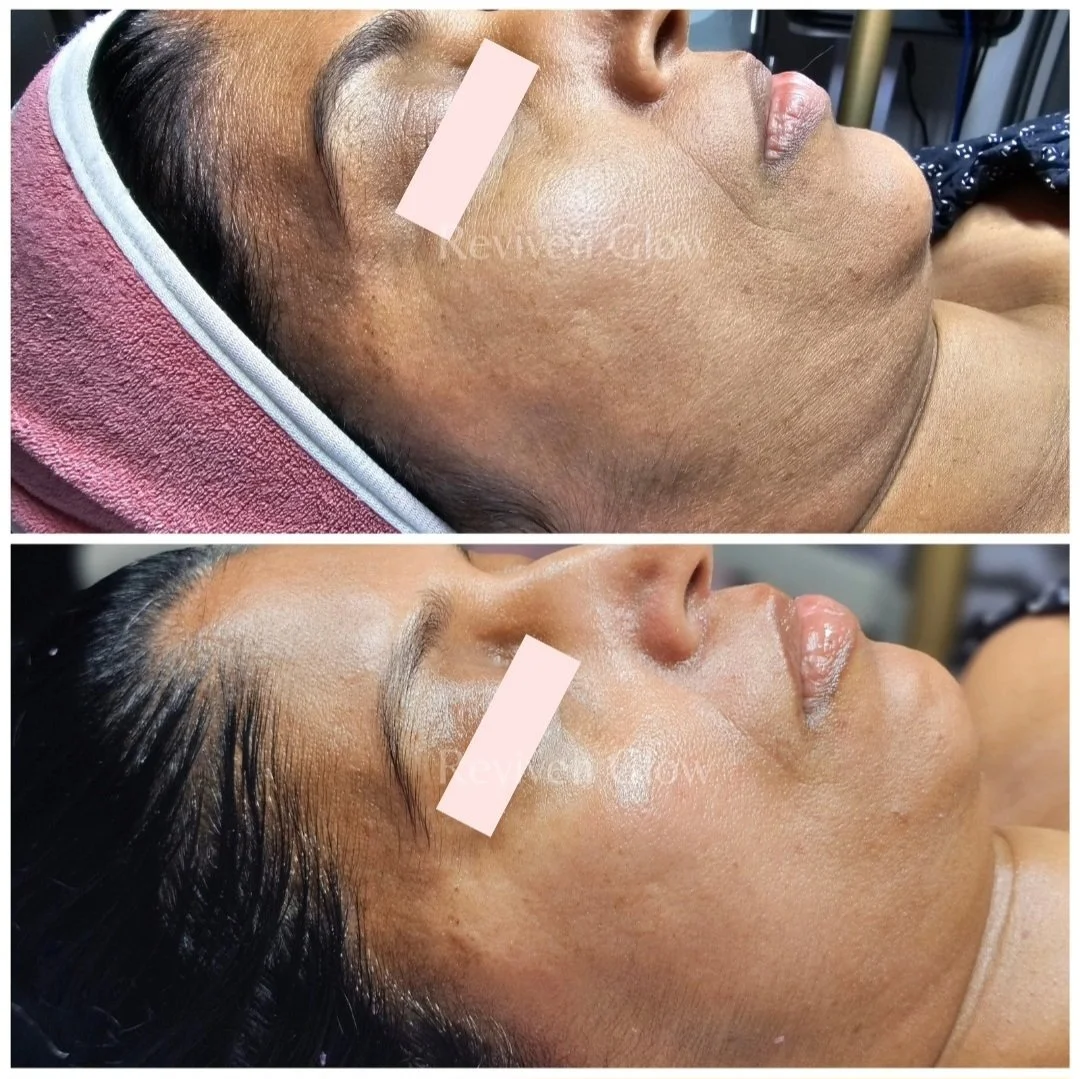 Before and after images of a woman's face showing skin improvement, with the woman lying down, eyes closed, and a towel covering her head.
