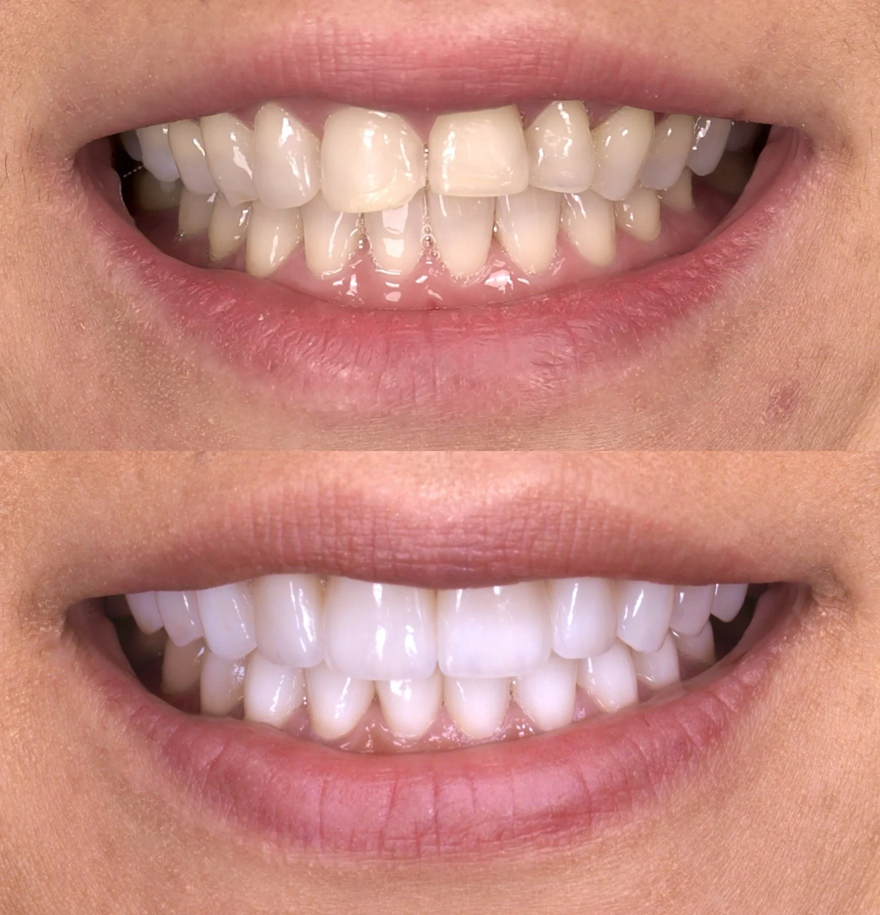24 Veneers in Shade 0.5M1