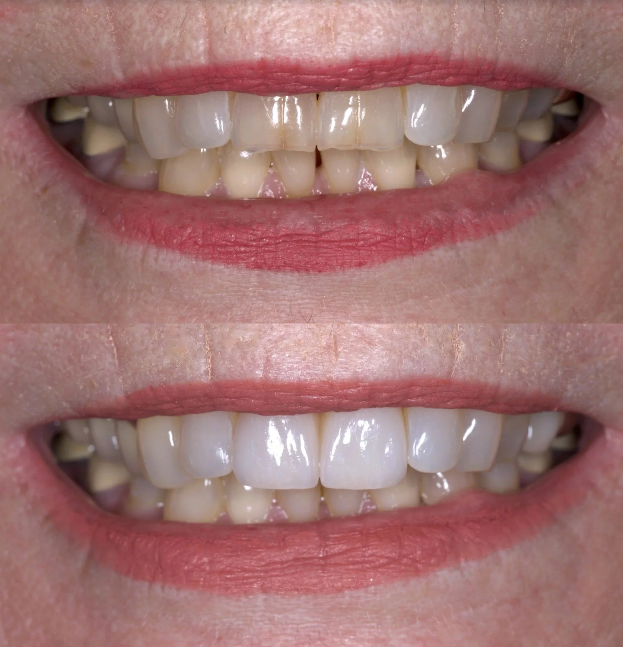 Veneers in Newport Beach by Jeremy Heldt, DDS