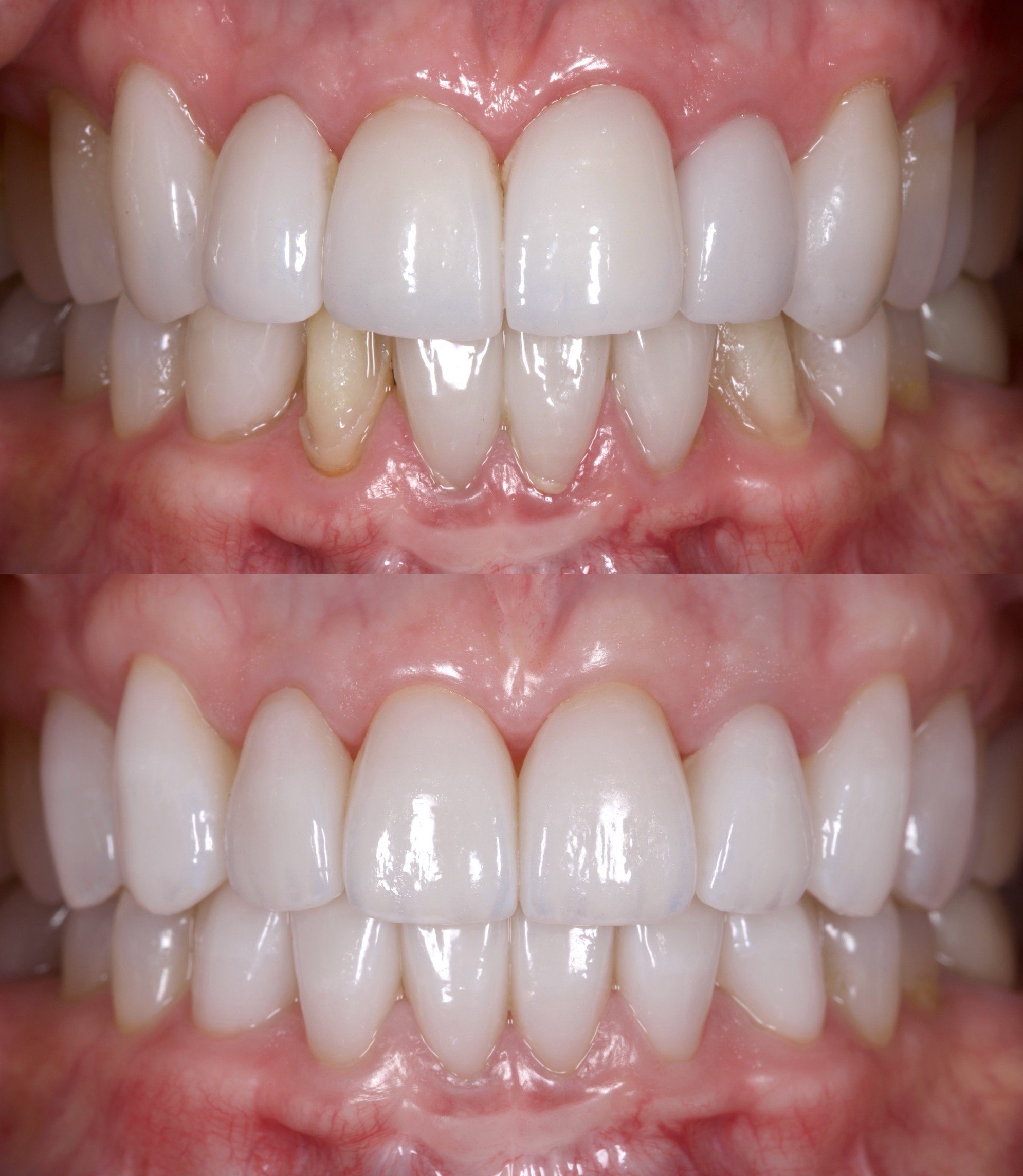 Previous Veneers and New Veneers