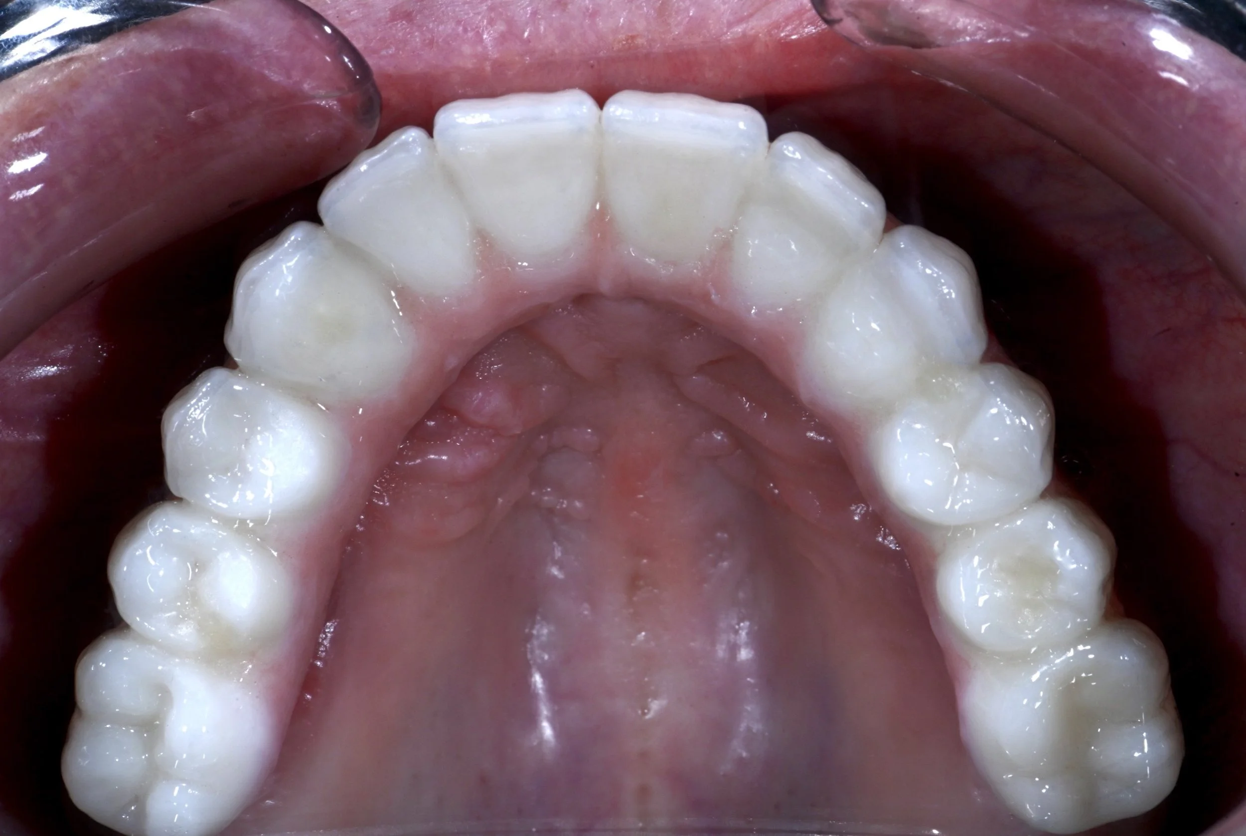 Composite placed in Access Channels