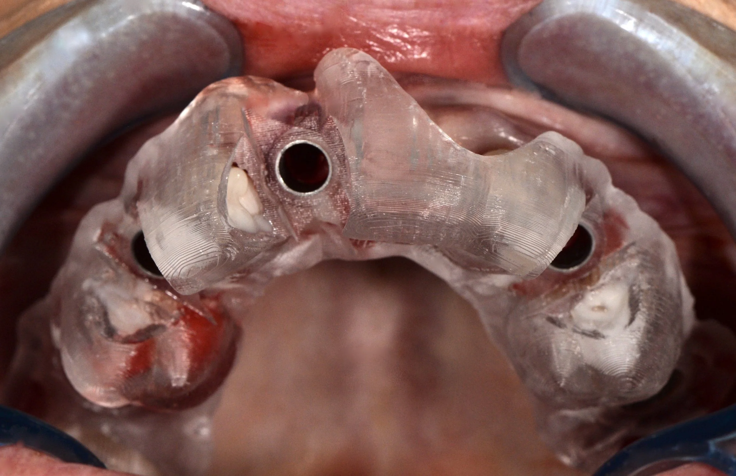 Fully-Guided Surgical Stent