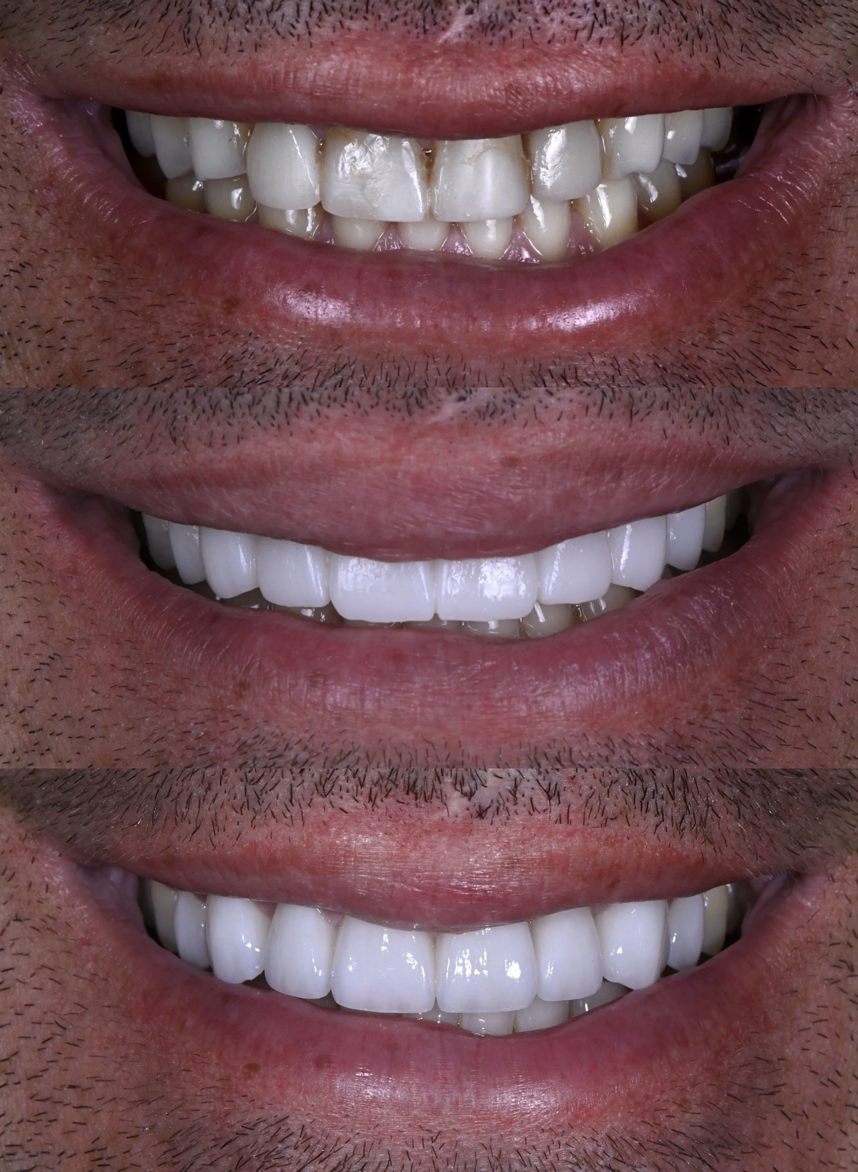 Condition, Temps, Veneers
