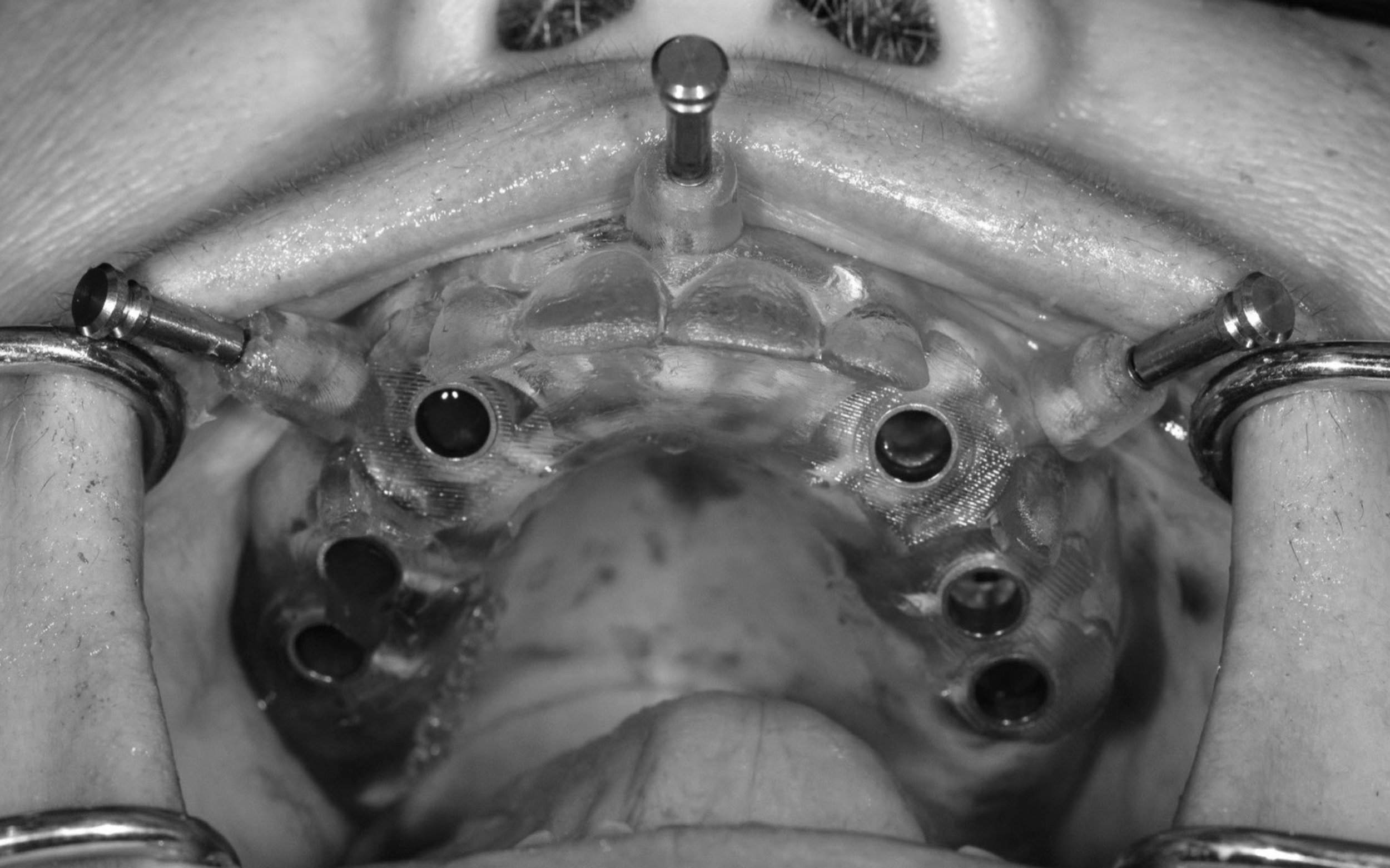 Fully Guided Surgical Stent