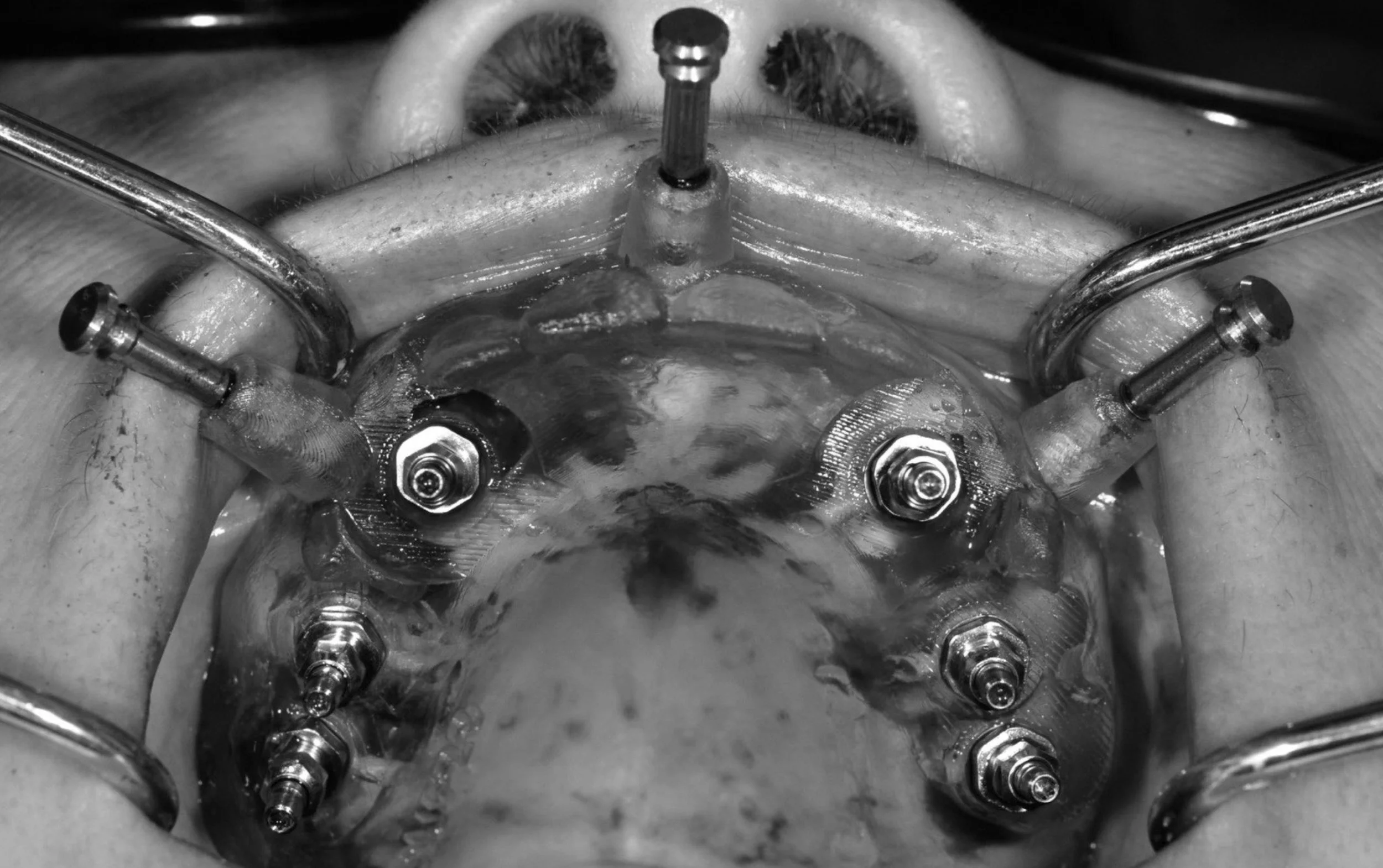 Fully Guided Surgical Stent