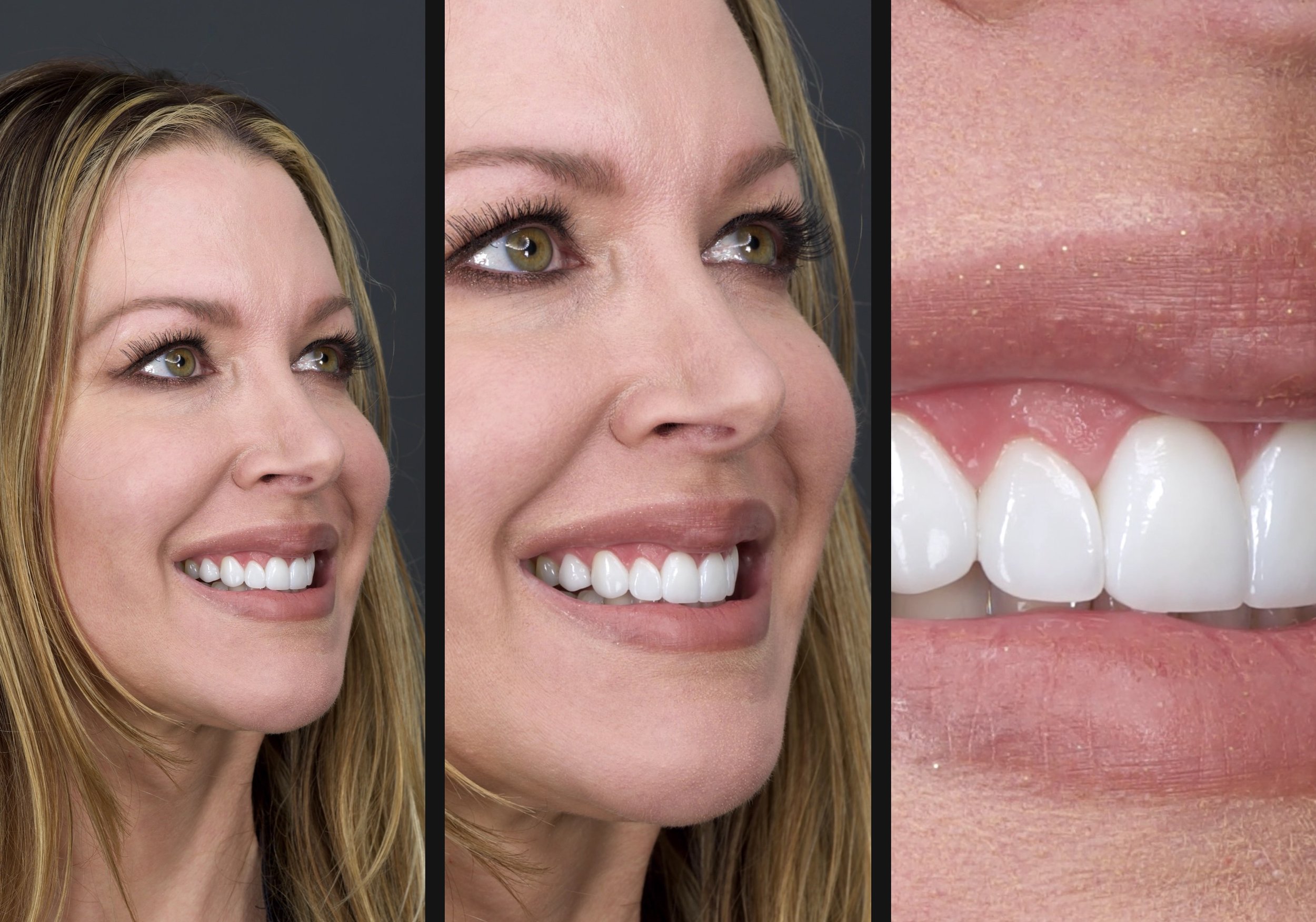 Porcelain Veneers, Orange County