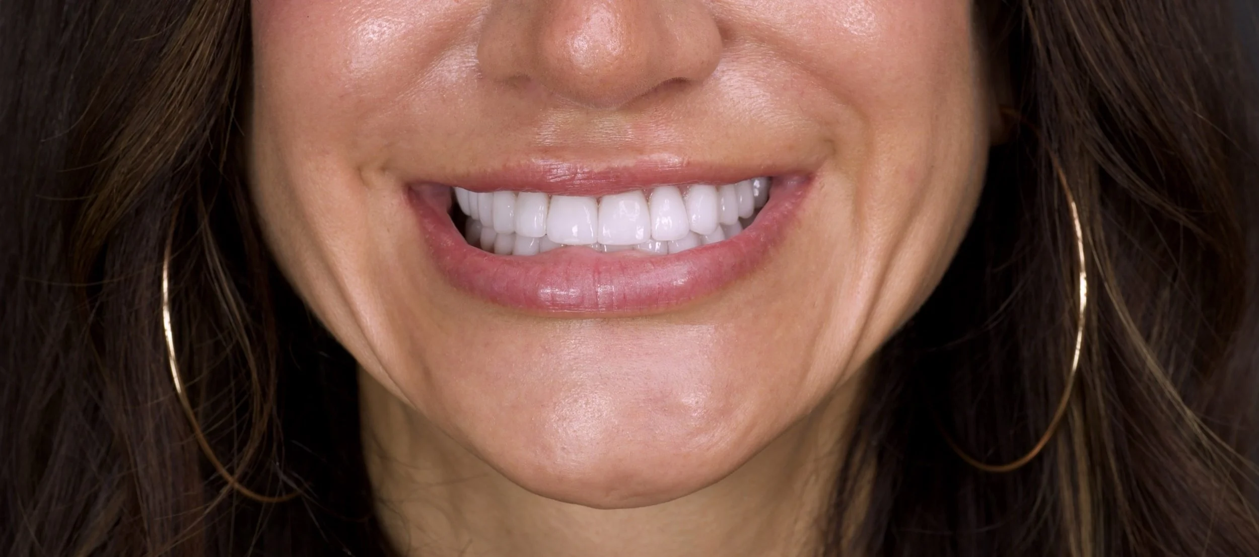 28 Veneers in Newport Beach