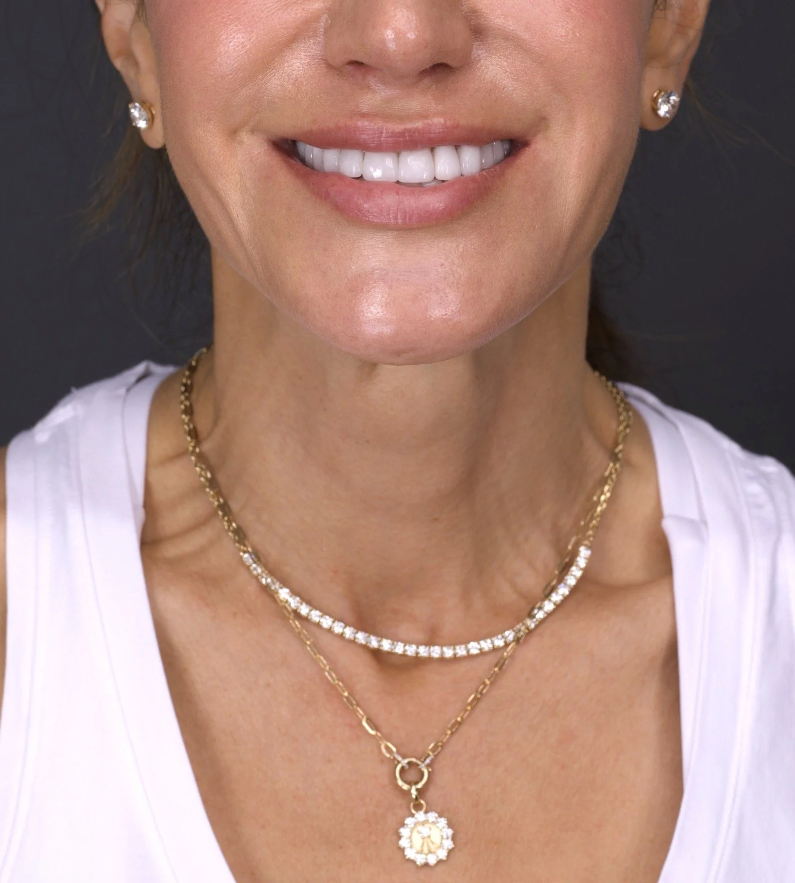 28 Veneers in Newport Beach