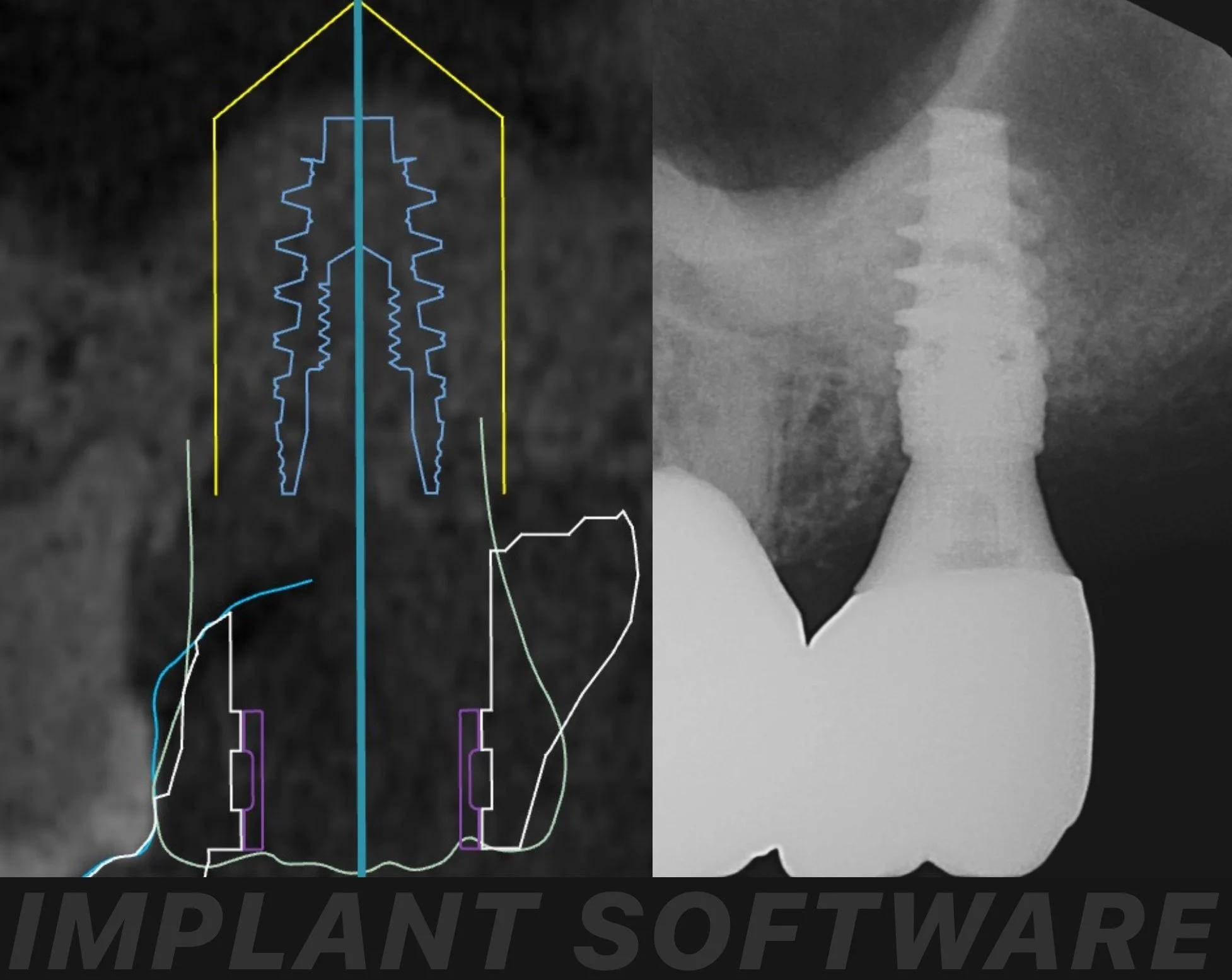 Guided Dental Implant Surgery