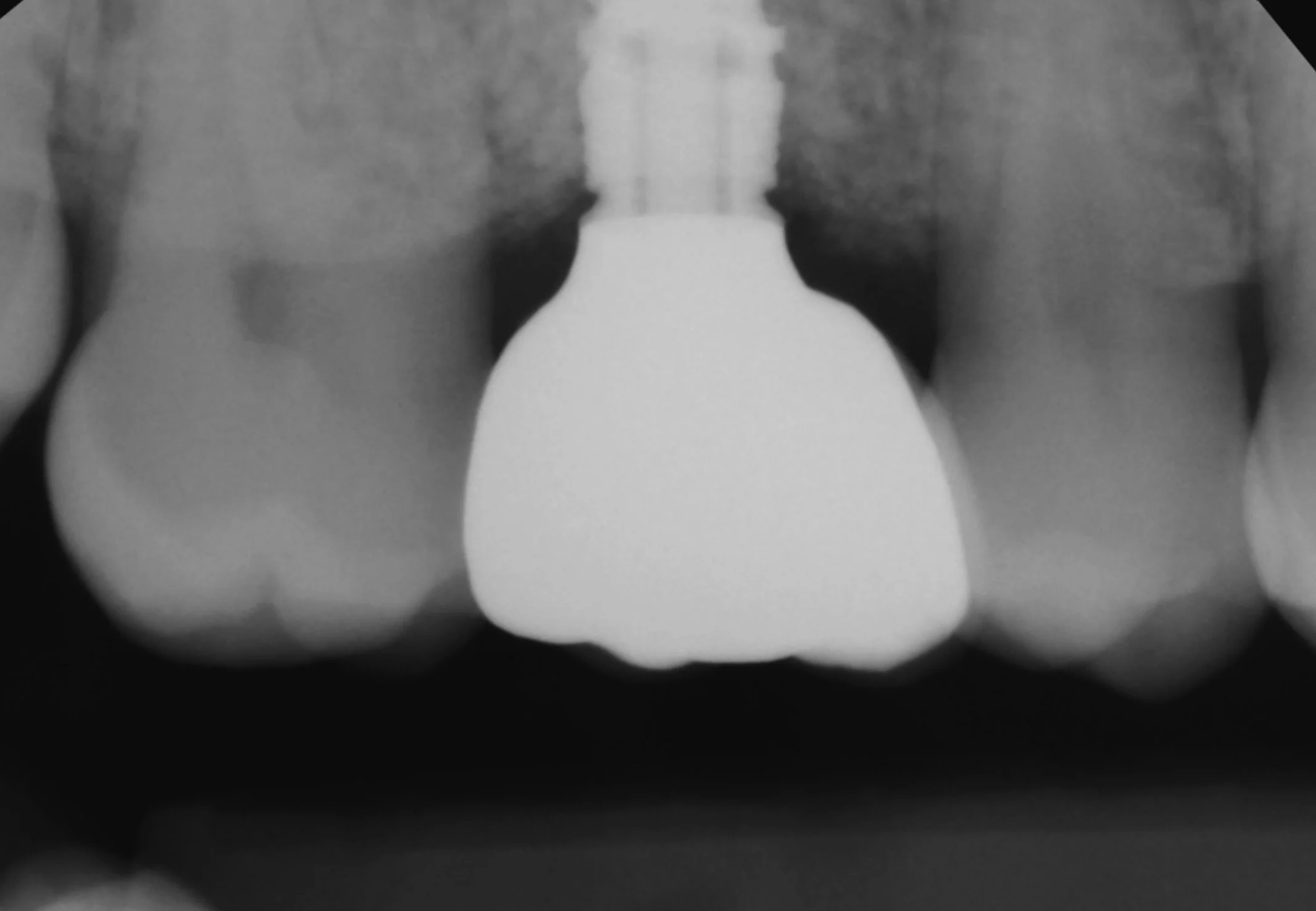  Titanium connection to the implant with the ASC adapter.  Zirconia material contacts tissue for the best adhesion and aesthetics. 