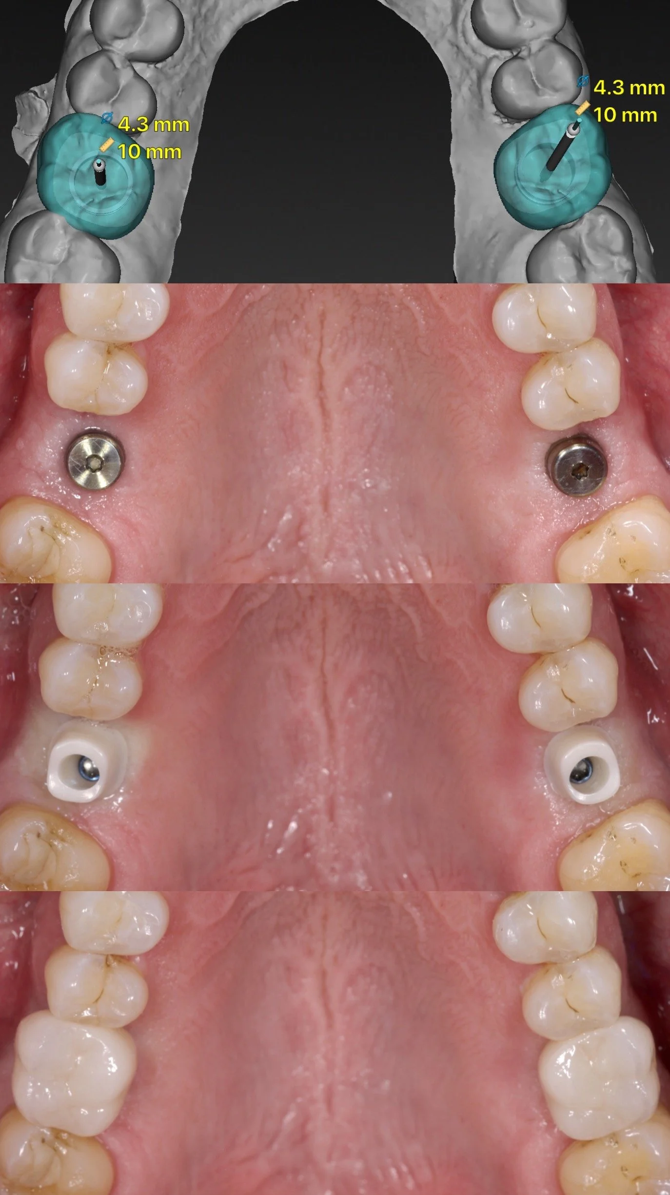 Zirconia is the most tissue friendly material for abutments.  The ASC abutment by Nobel Biocare is the Dr. Heldt’s preferred choice not only best for tissue but it also gives the most aesthetic results since the zirconia comes in different shades.  