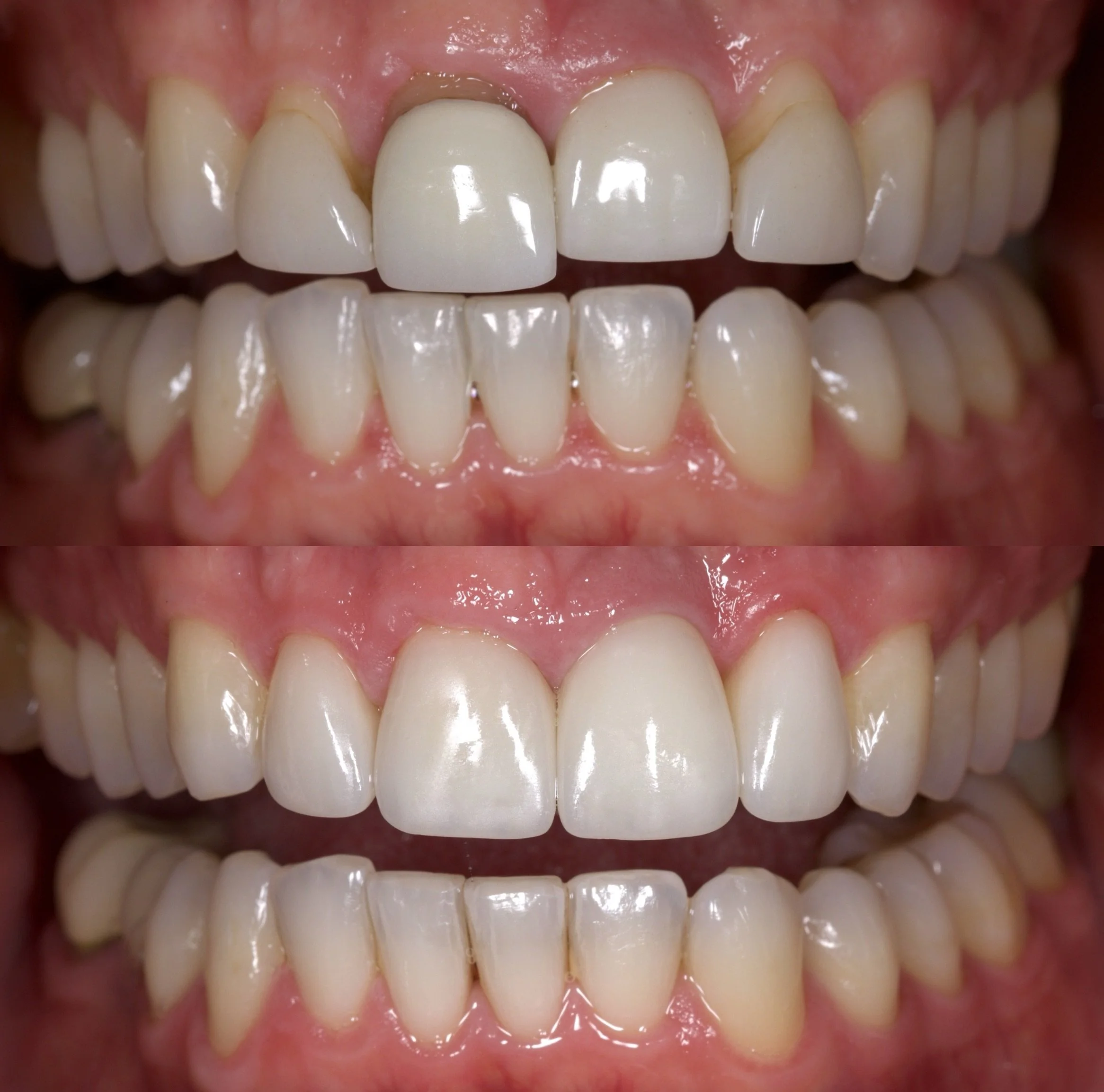 2 Veneers + 2 Crowns in Shade B1