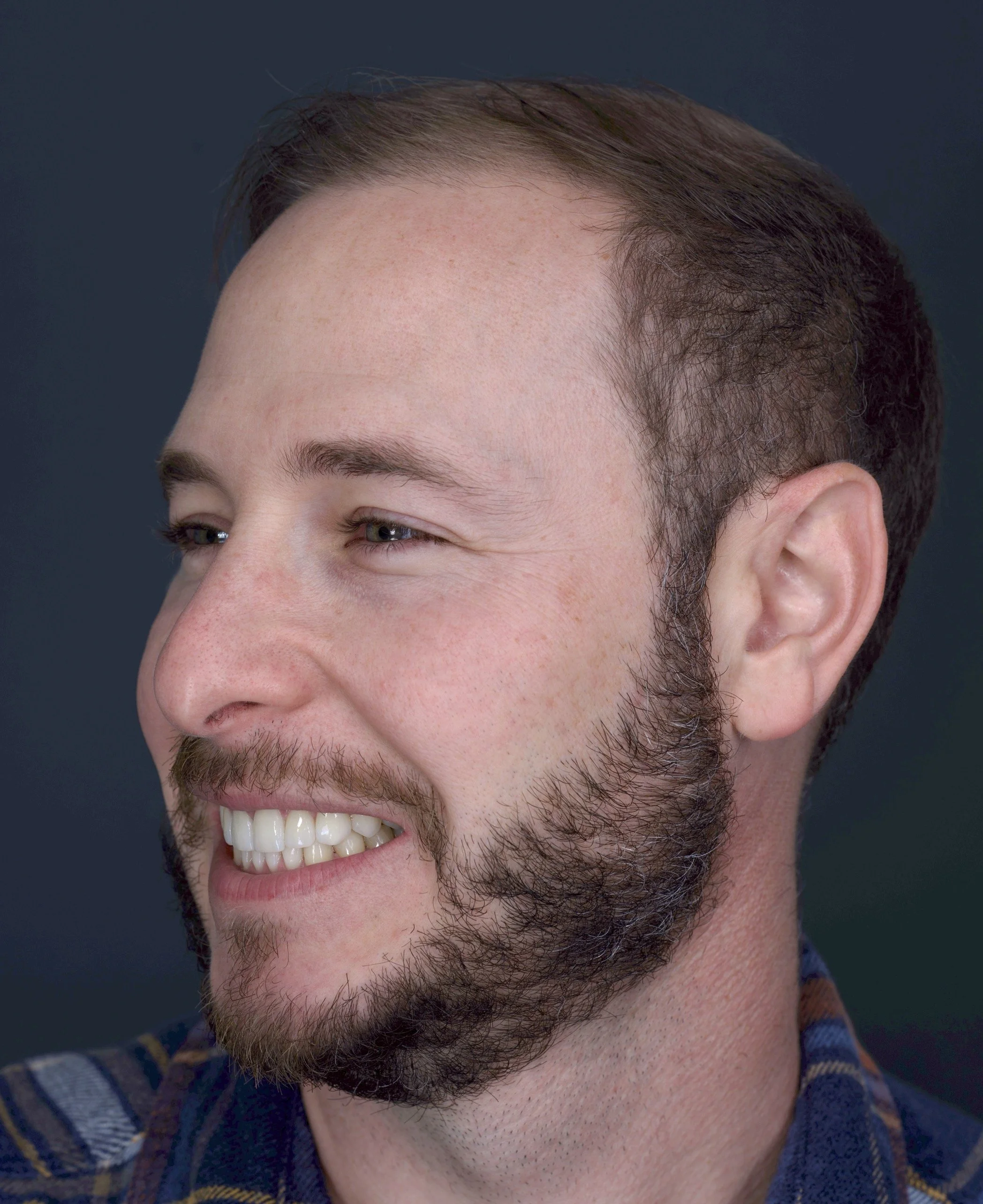 6 Porcelain Veneers
