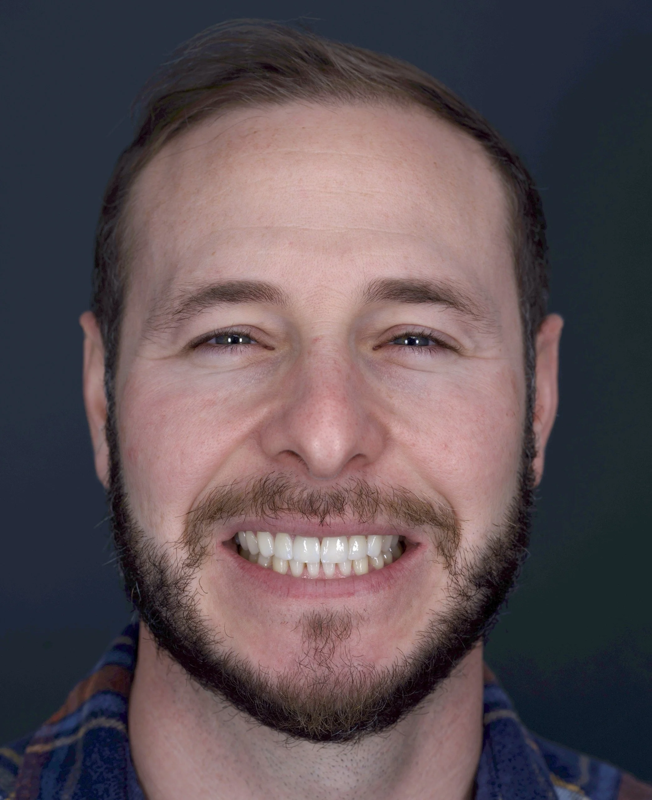 6 Porcelain Veneers