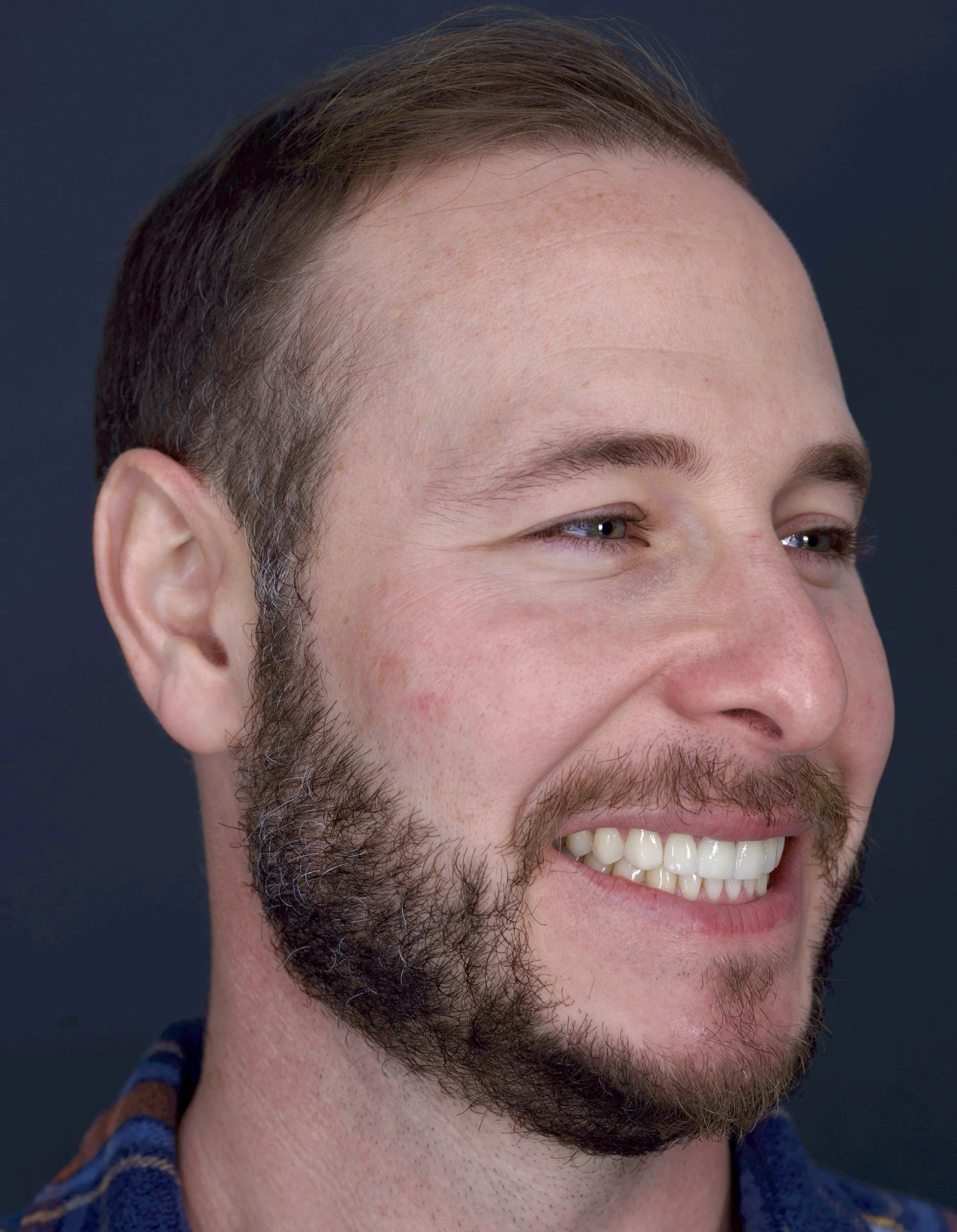 6 Porcelain Veneers