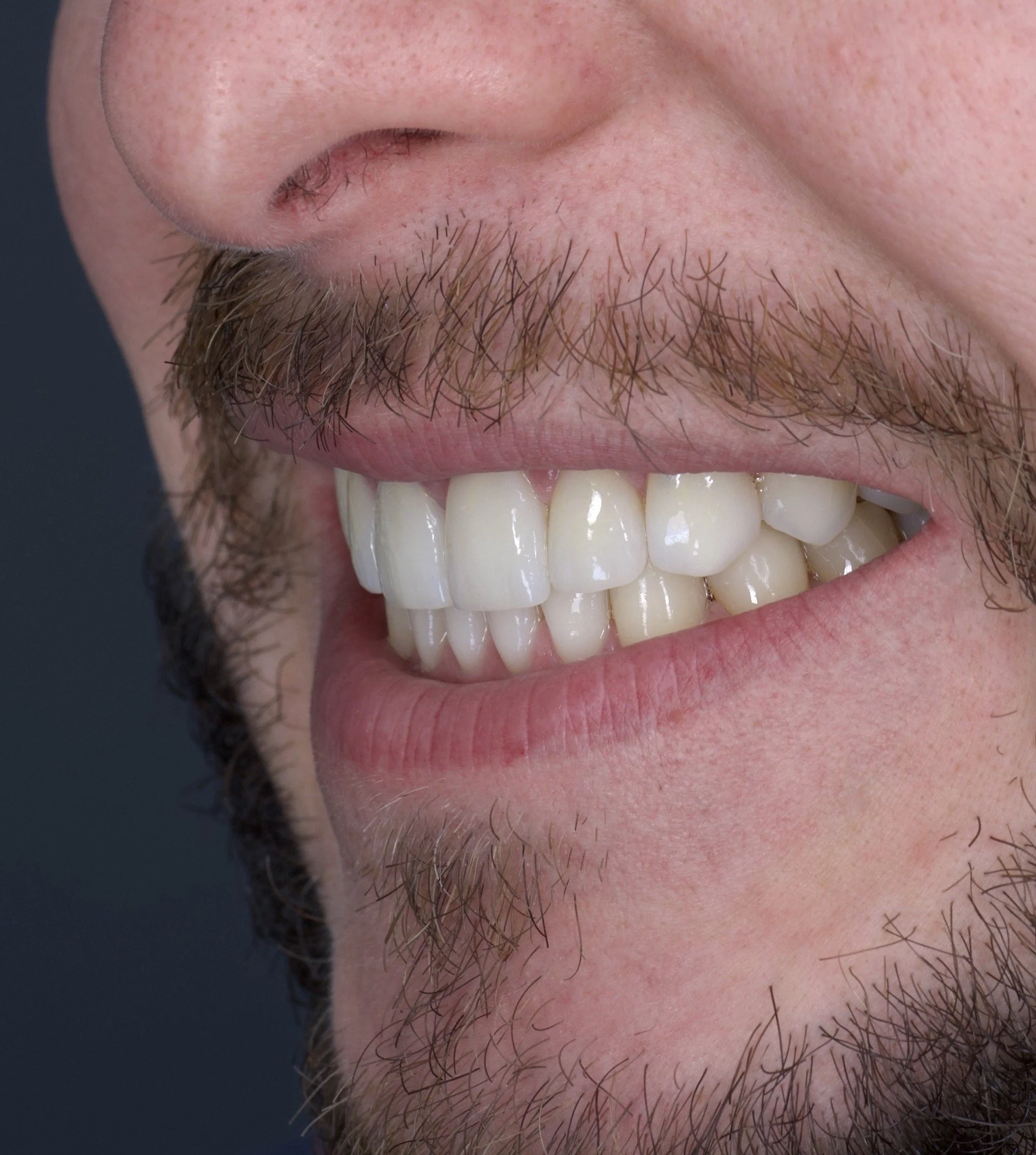 6 Porcelain Veneers