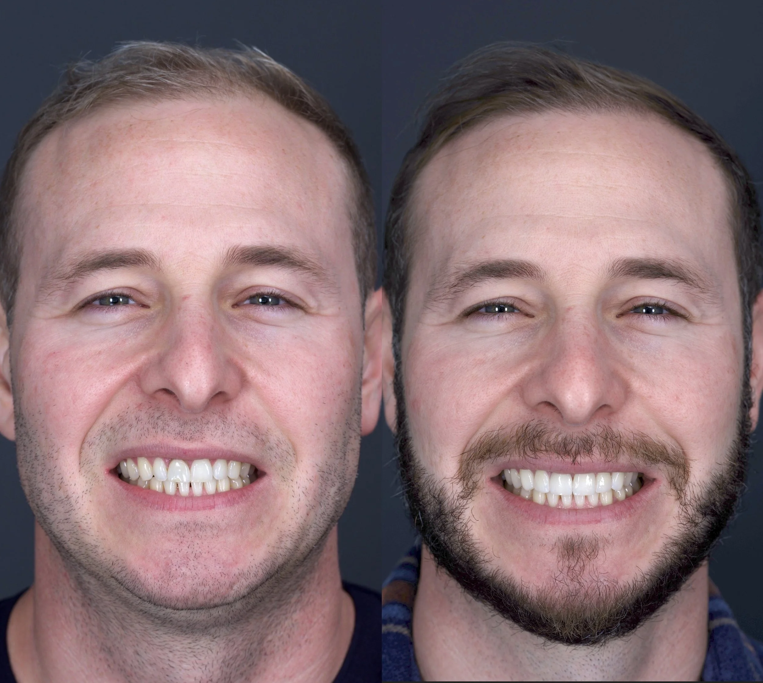 6 Porcelain Veneers