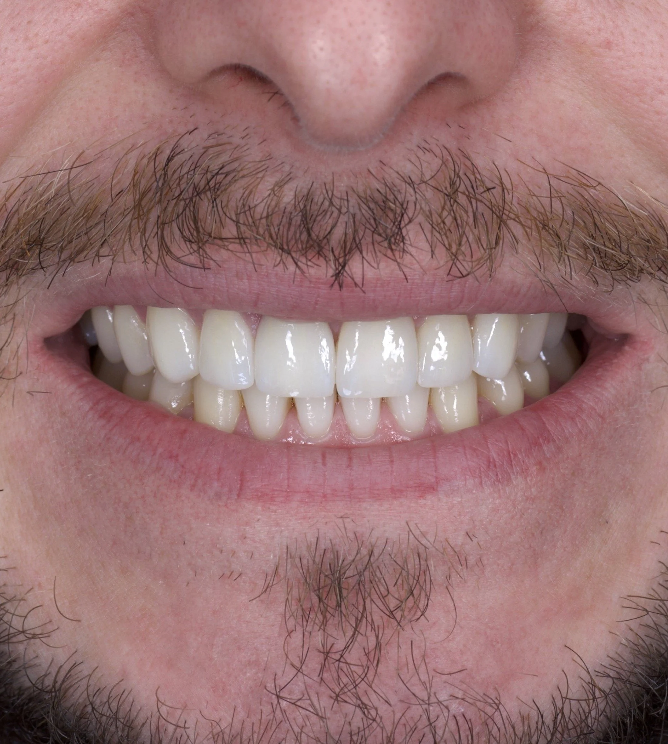 6 Porcelain Veneers