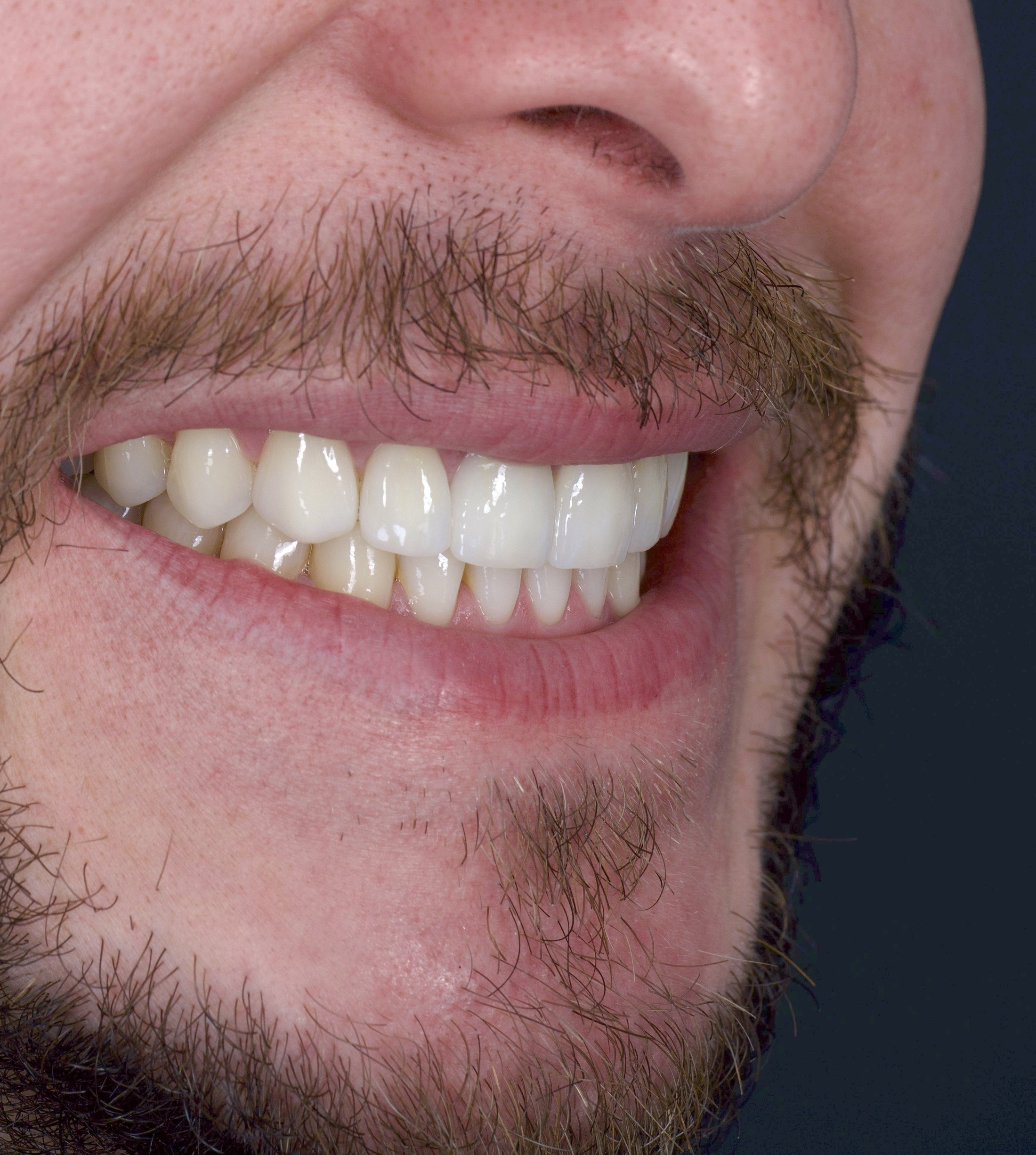 6 Porcelain Veneers