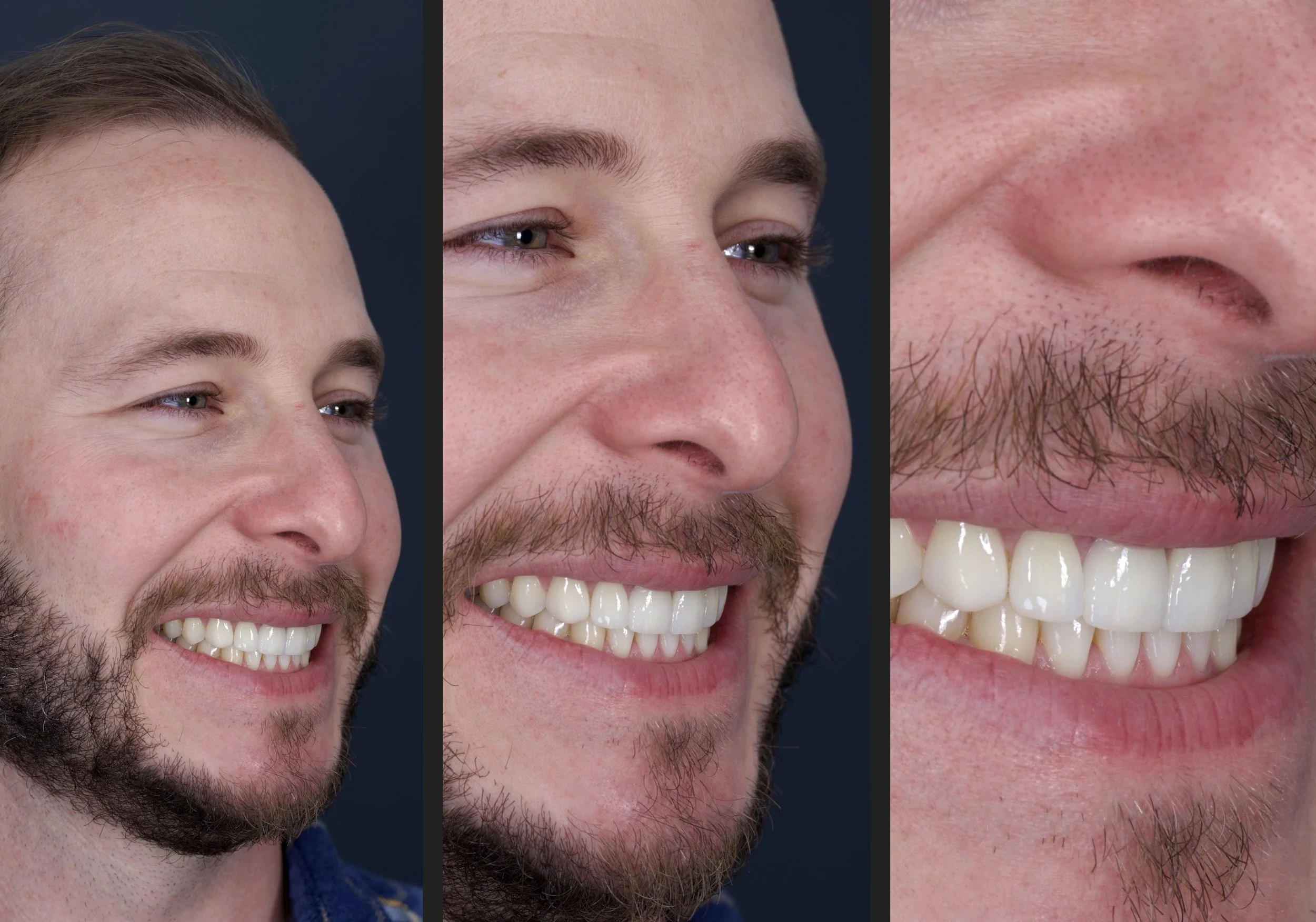 6 Porcelain Veneers