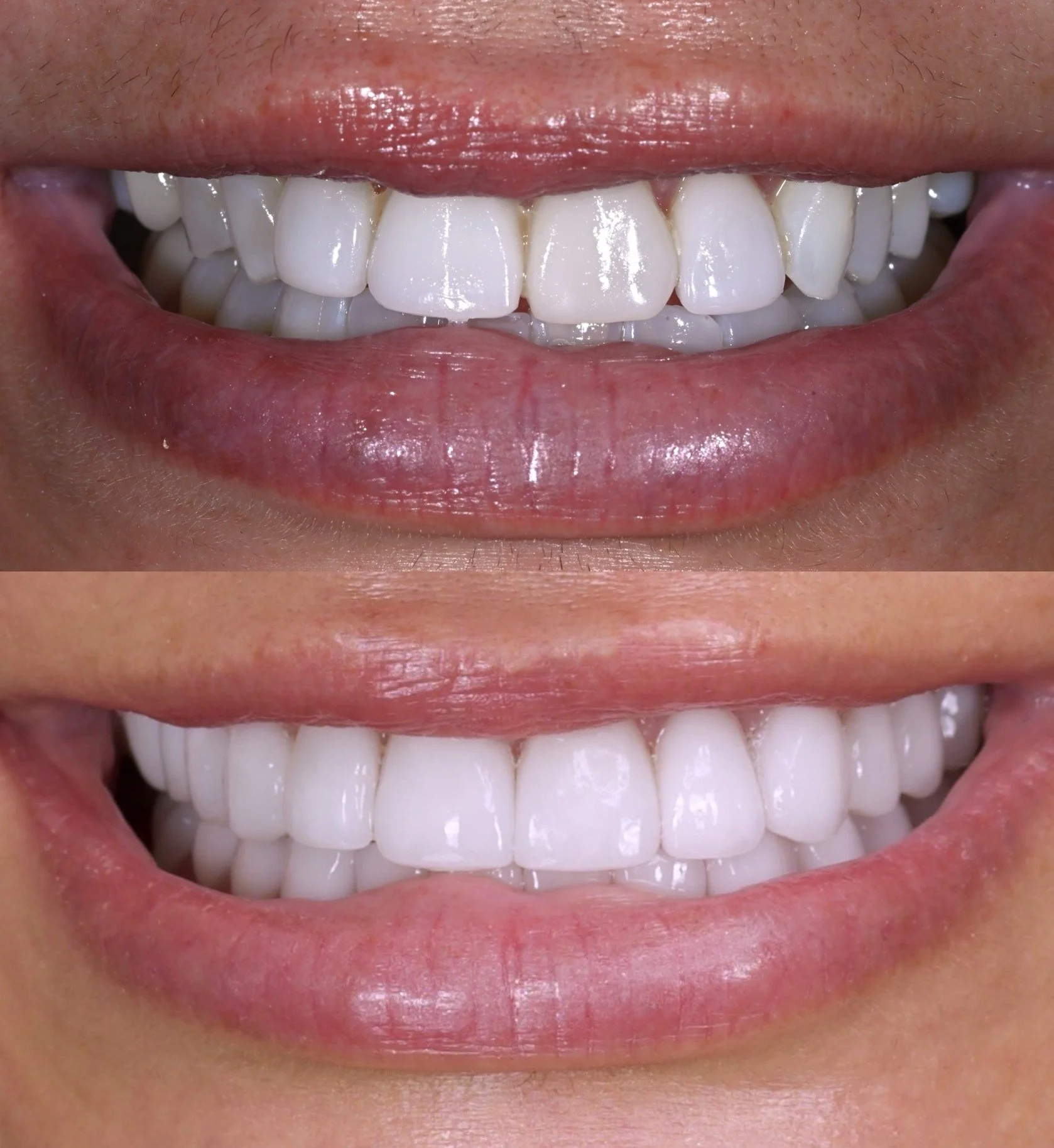 28 Veneers in Newport Beach