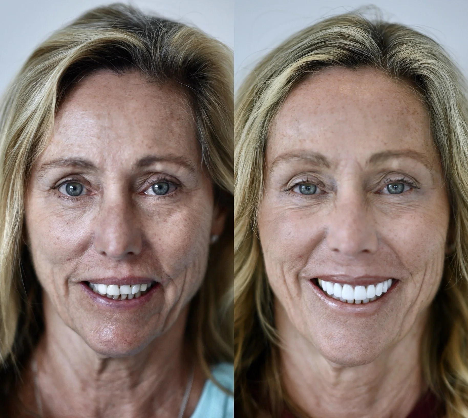 8 Veneers in Shade OM1 (LT)
