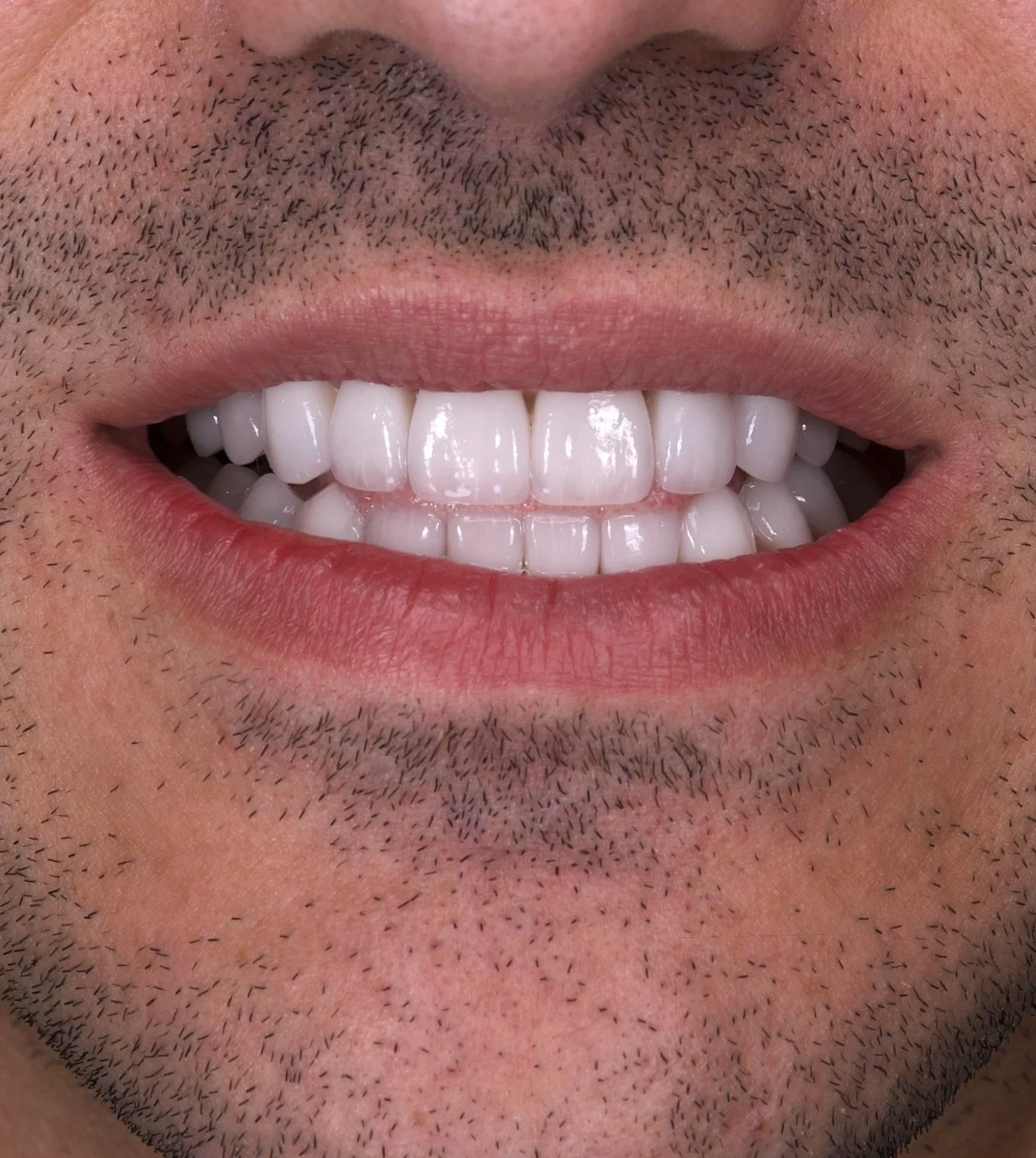 Super High Translucency