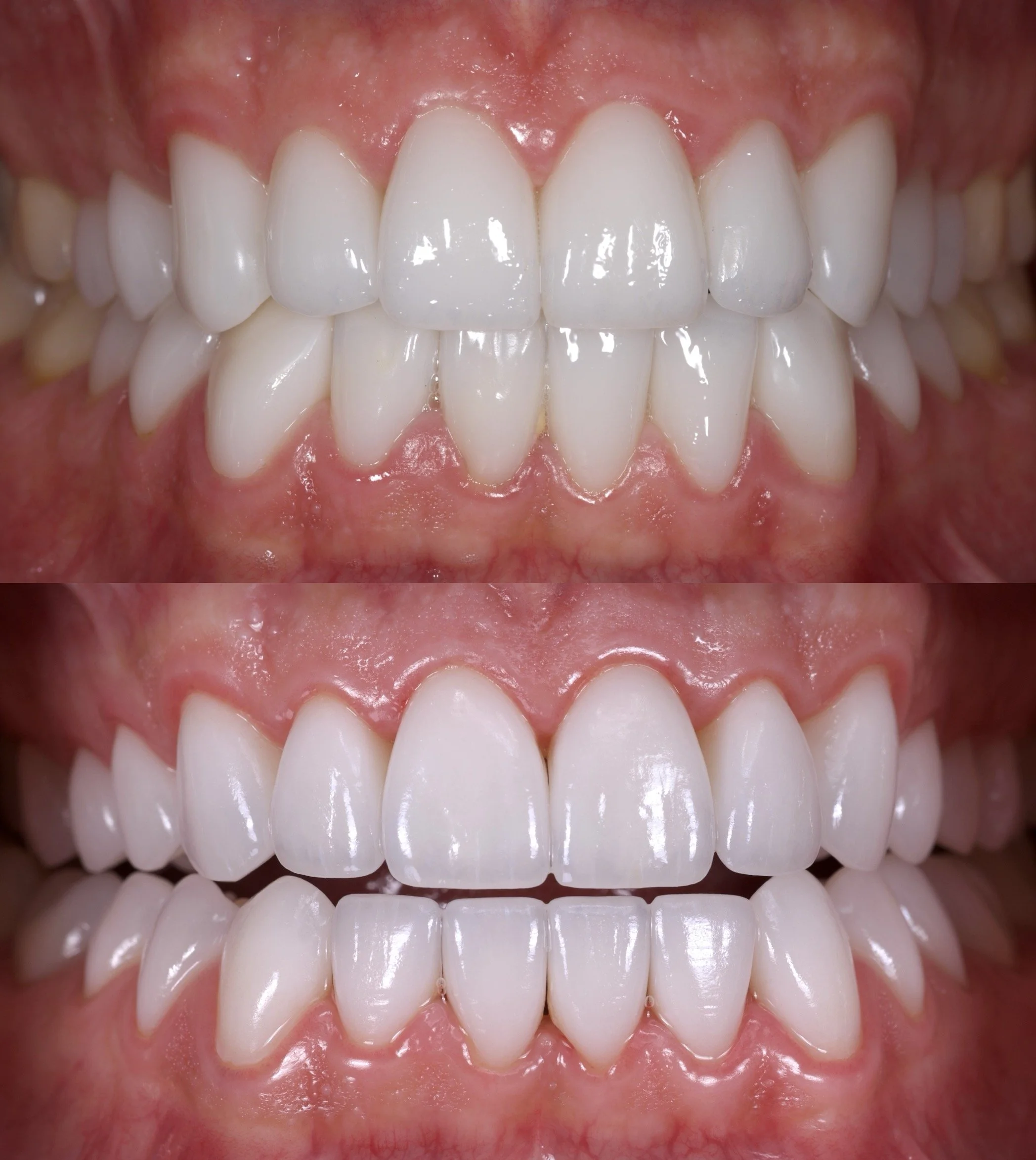 28 Veneers in Shade BL2 in High Translucency