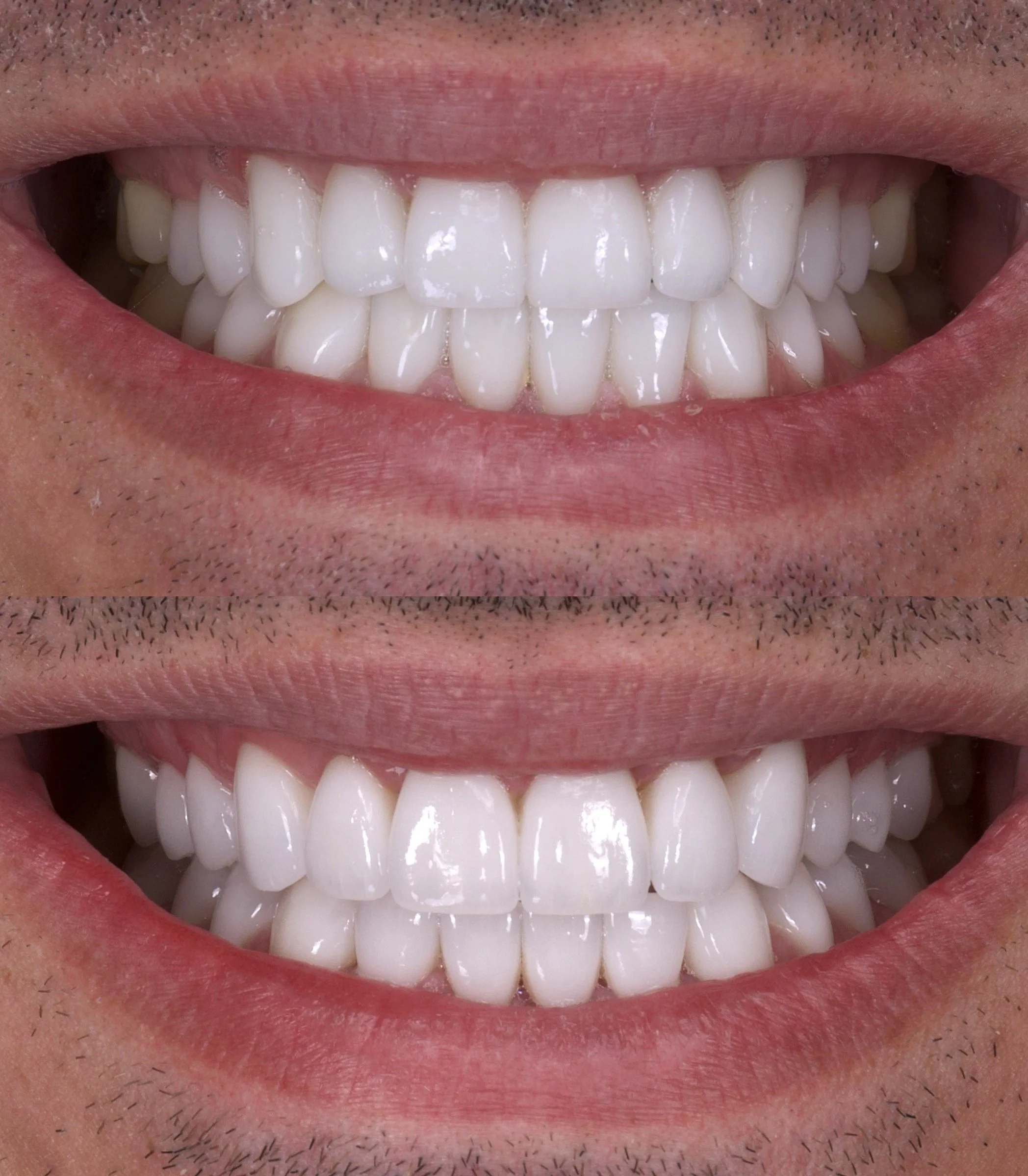 28 Veneers in Shade BL2 in High Translucency