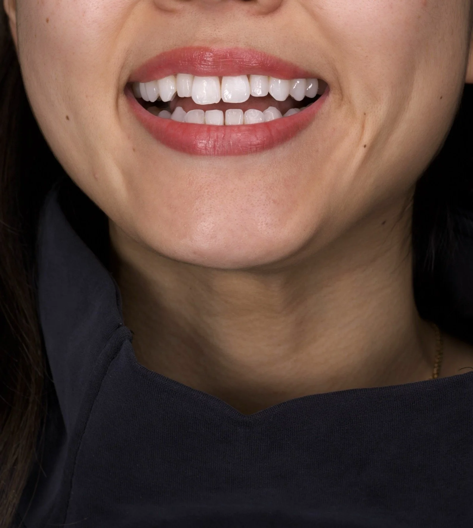 2 Minimal Prep Veneers Newport Beach