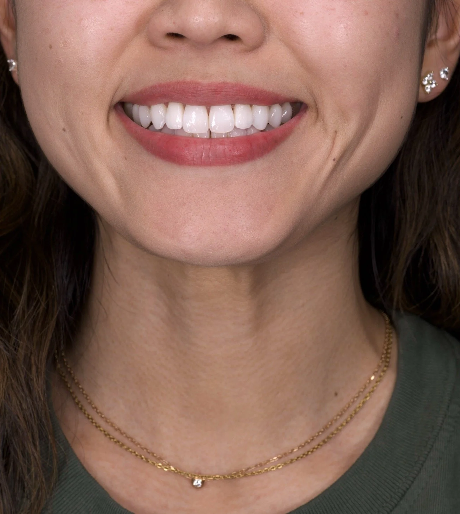 2 Minimal Prep Veneers Newport Beach