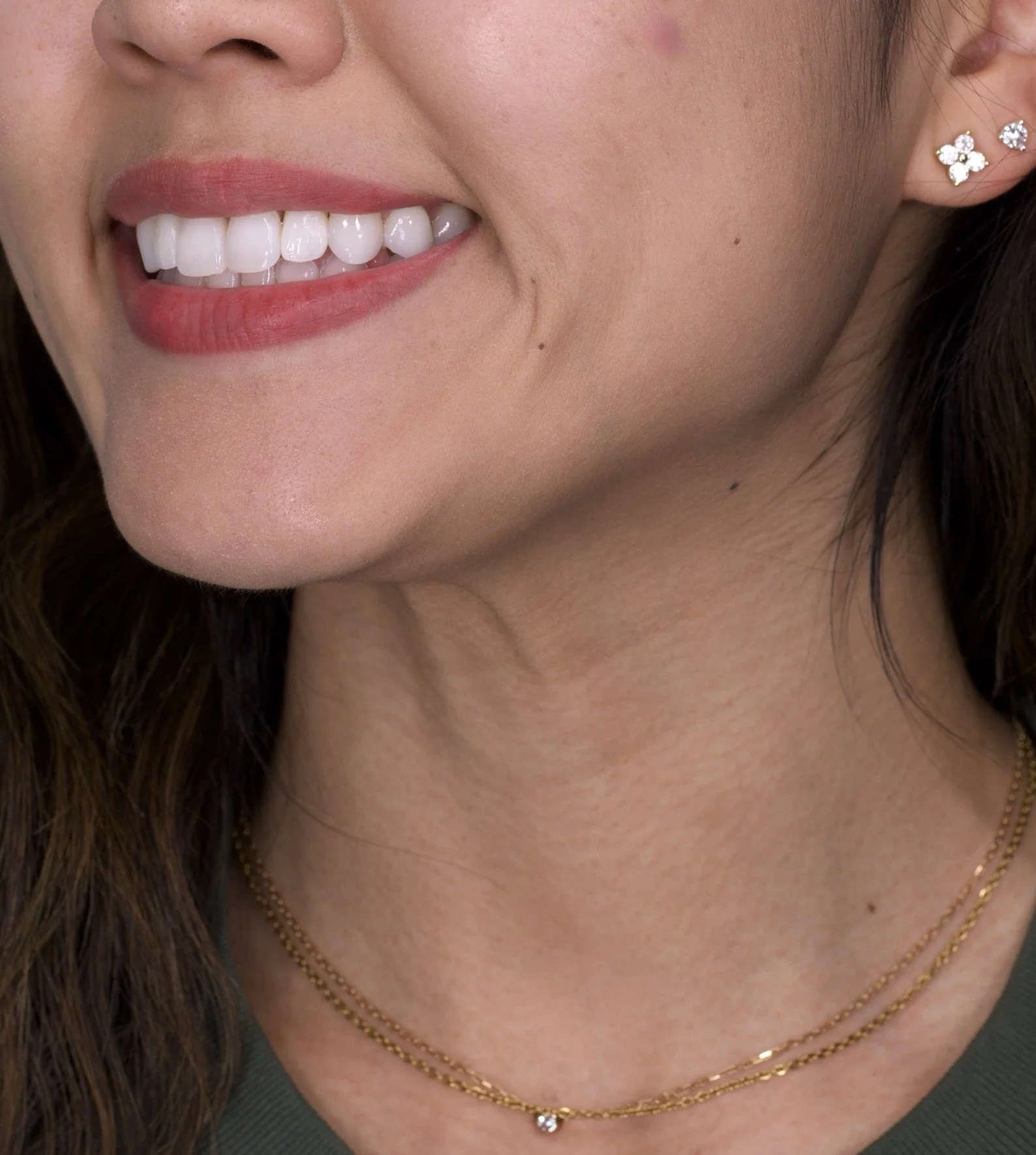 2 Minimal Prep Veneers Newport Beach