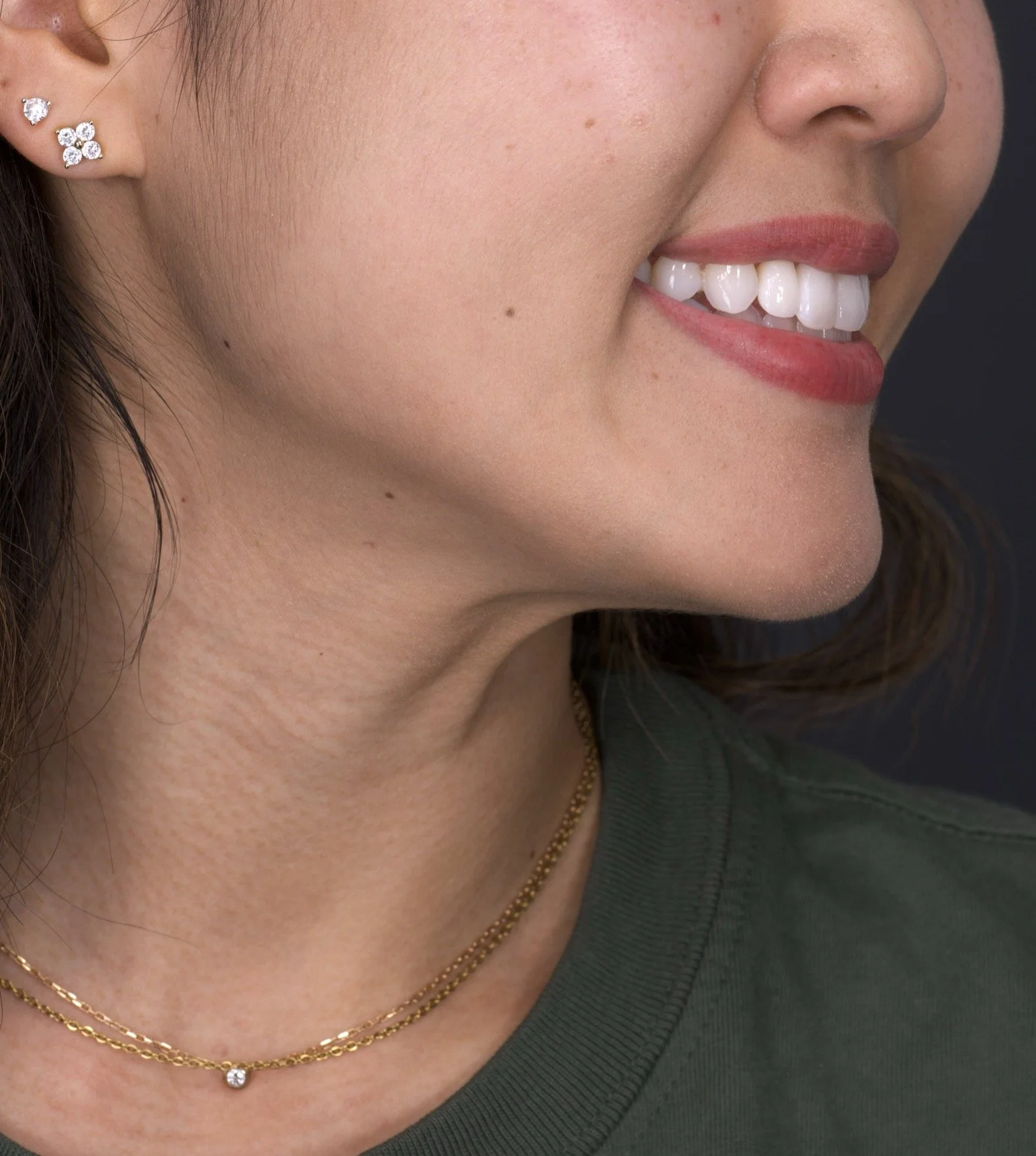 2 Minimal Prep Veneers Newport Beach