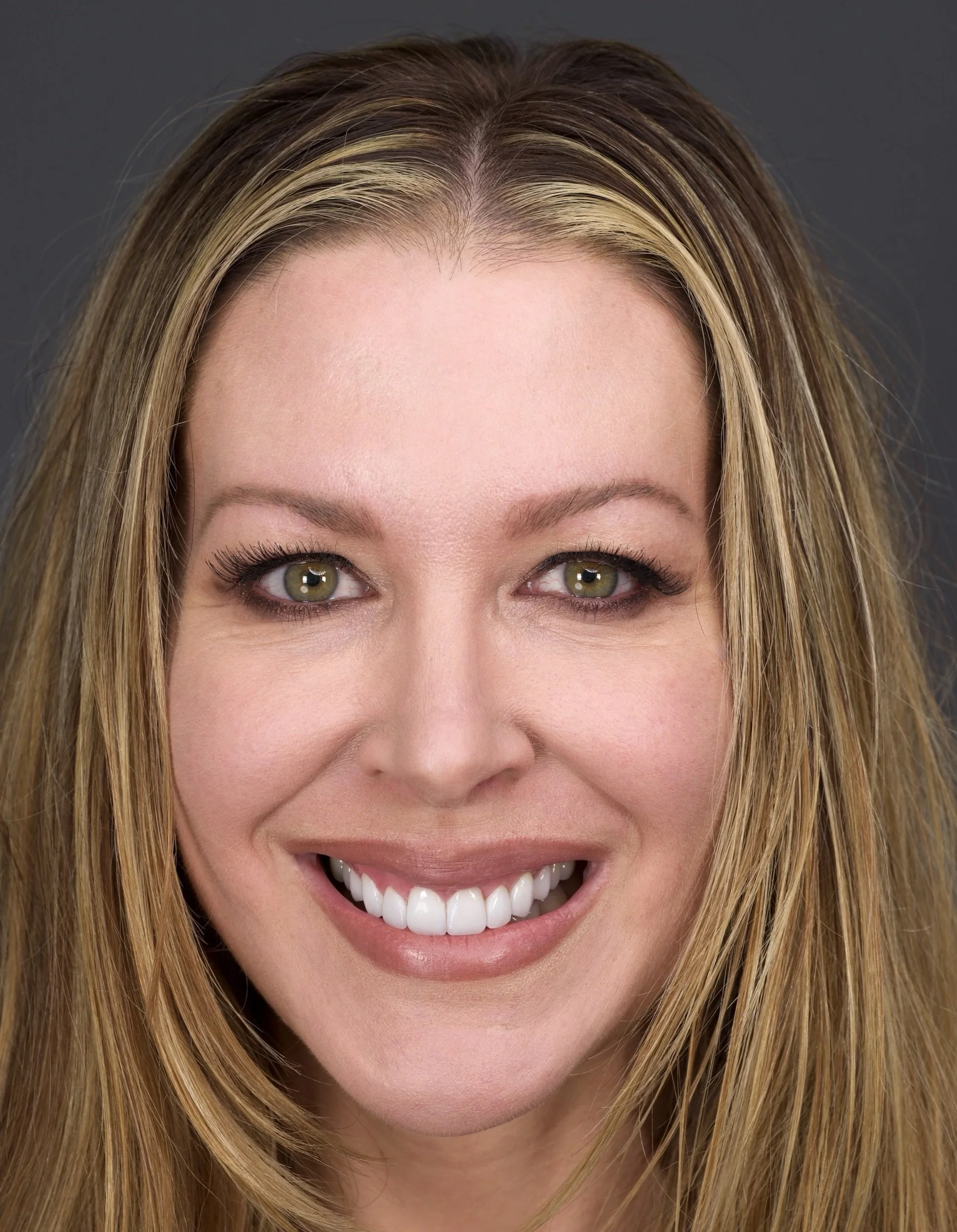 Porcelain Veneers by Jeremy Heldt, DDS in Newport Beach
